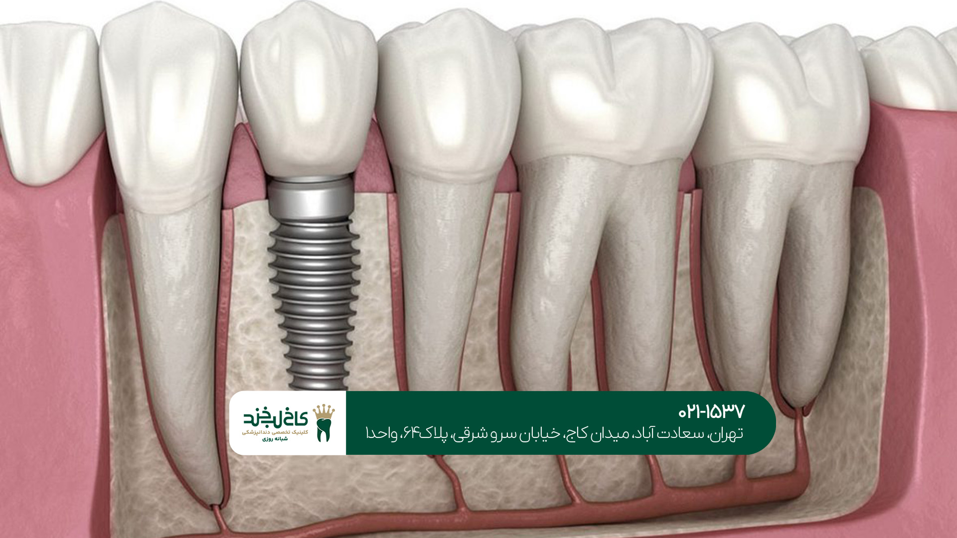 ایمپلنت دیجیتال دندان