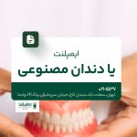 ایمپلنت یا دندان مصنوعی