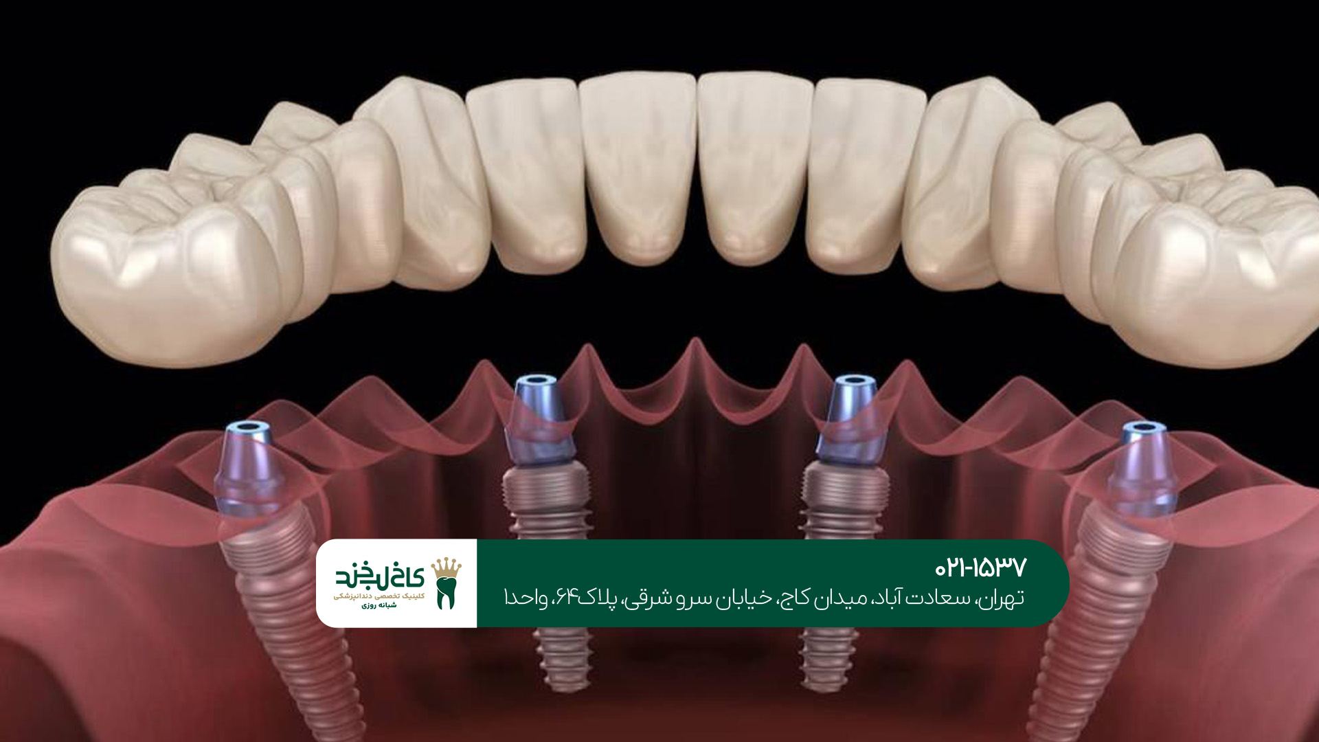 ایمپلنت دندان چیست؟