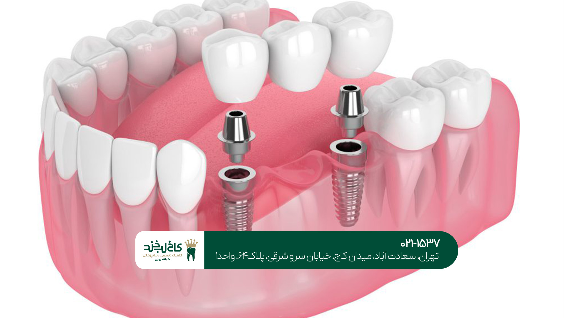 مراحل انجام ایمپلنت دندان در تهران