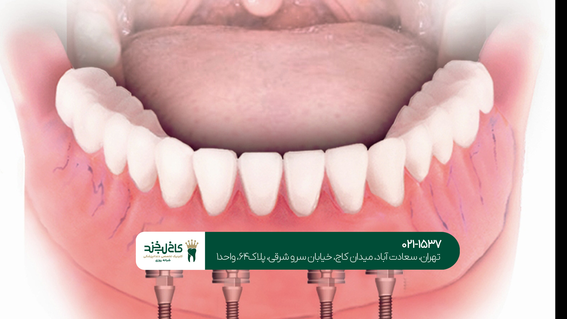 ایمپلنت دندان