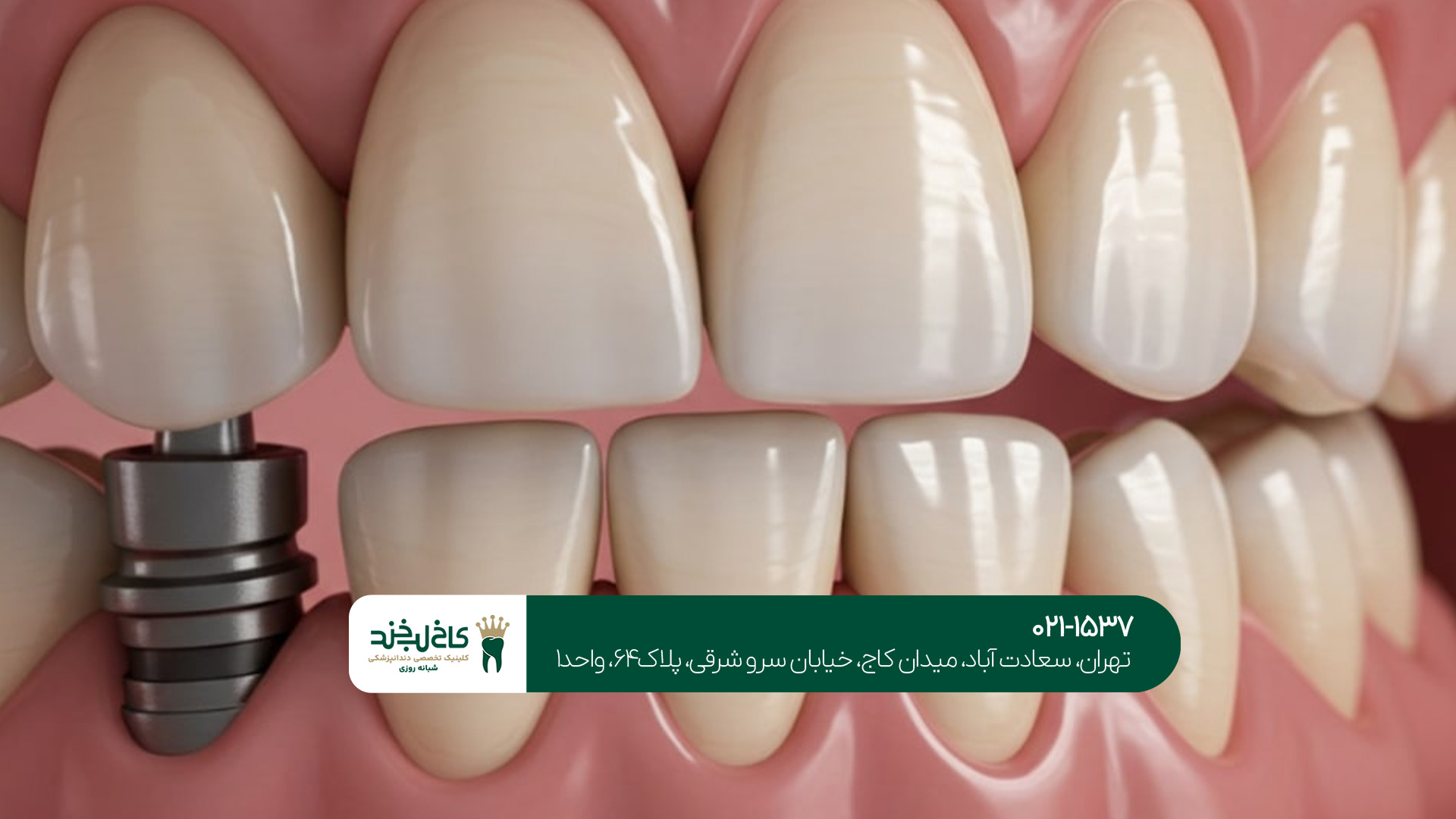 ایمپلنت یکروزه تهران ایمپلنت یکروزه تهران