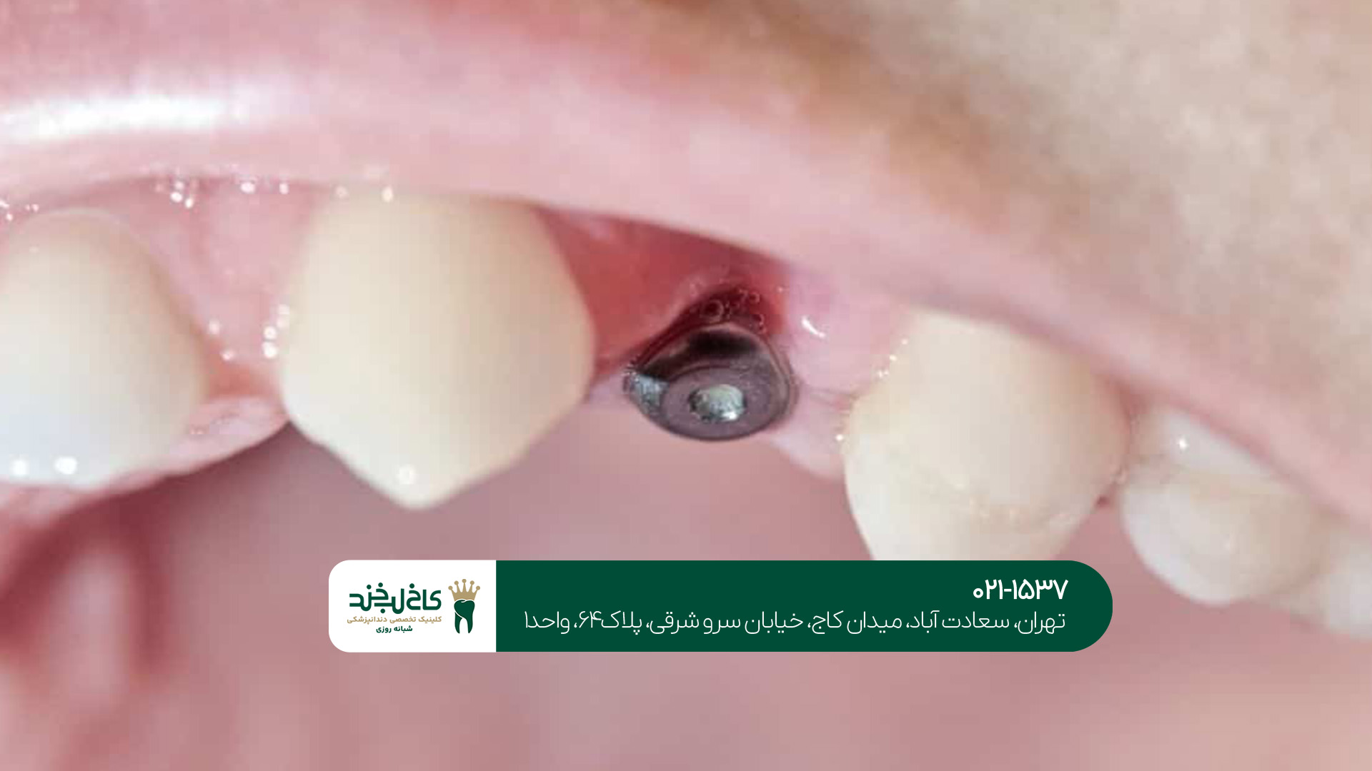 ایمپلنت یکروزه تهران ایمپلنت یکروزه تهران