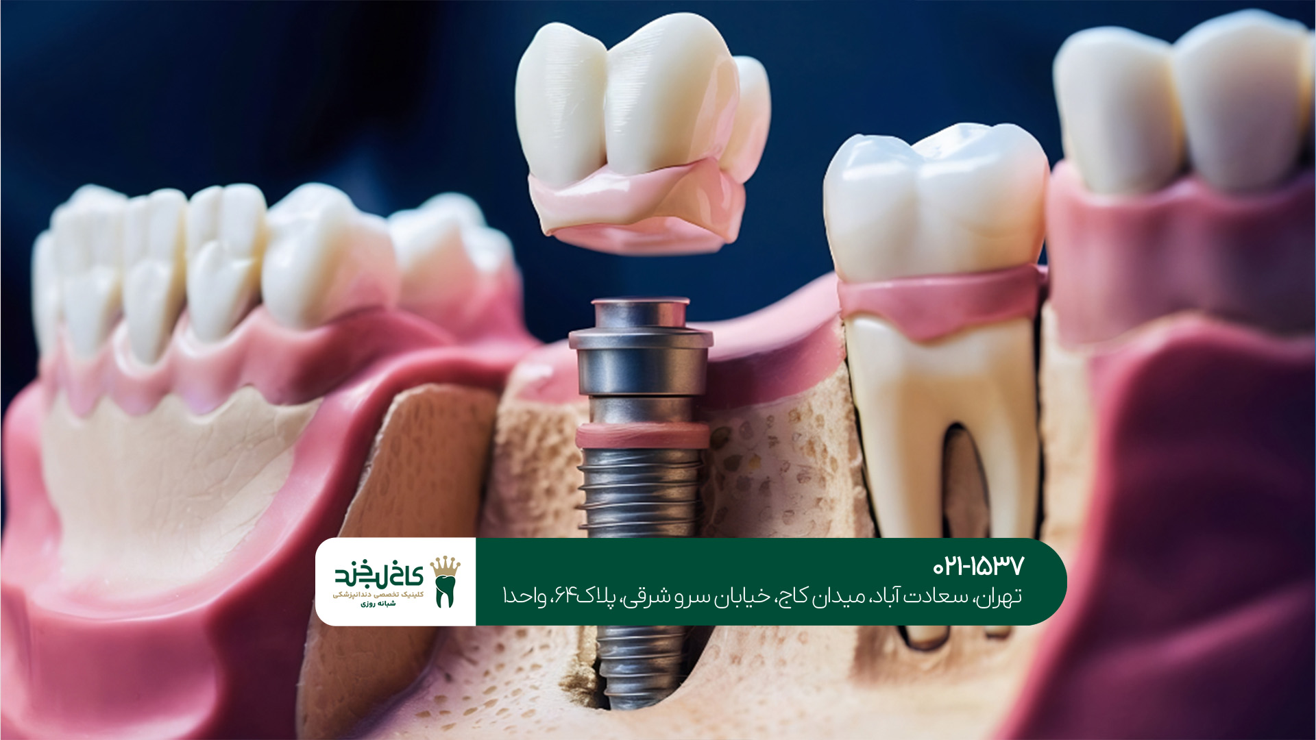 ایمپلنت یک‌روزه در شمال تهران
