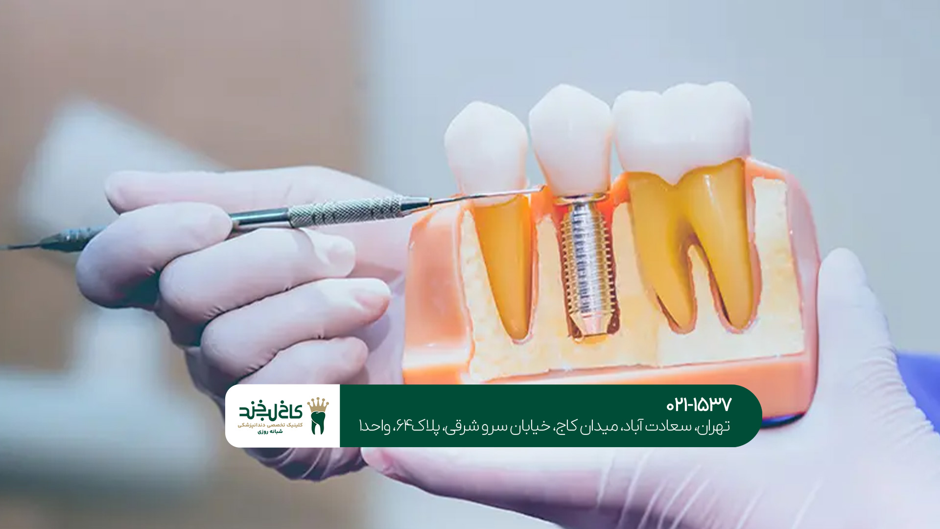 ایمپلنت یک‌روزه در شمال تهران