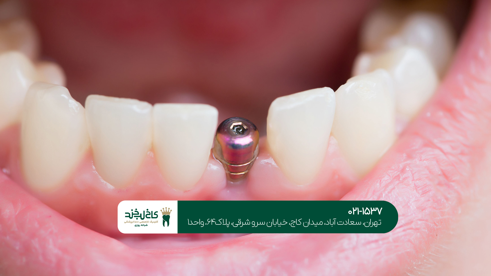 بهترین دندانپزشکی ایمپلنت در تهران