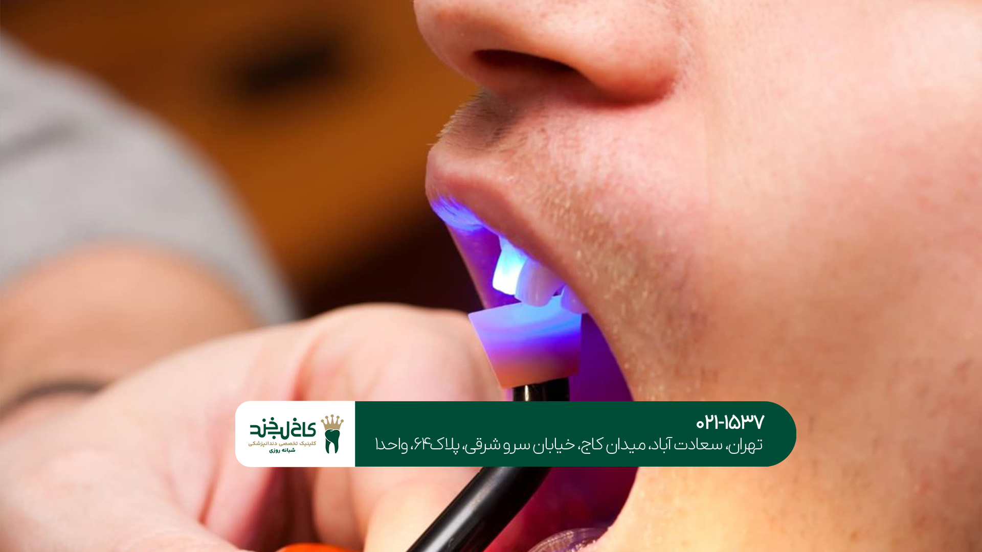 بهترین دکتر کامپوزیت تهران بهترین دکتر کامپوزیت تهران