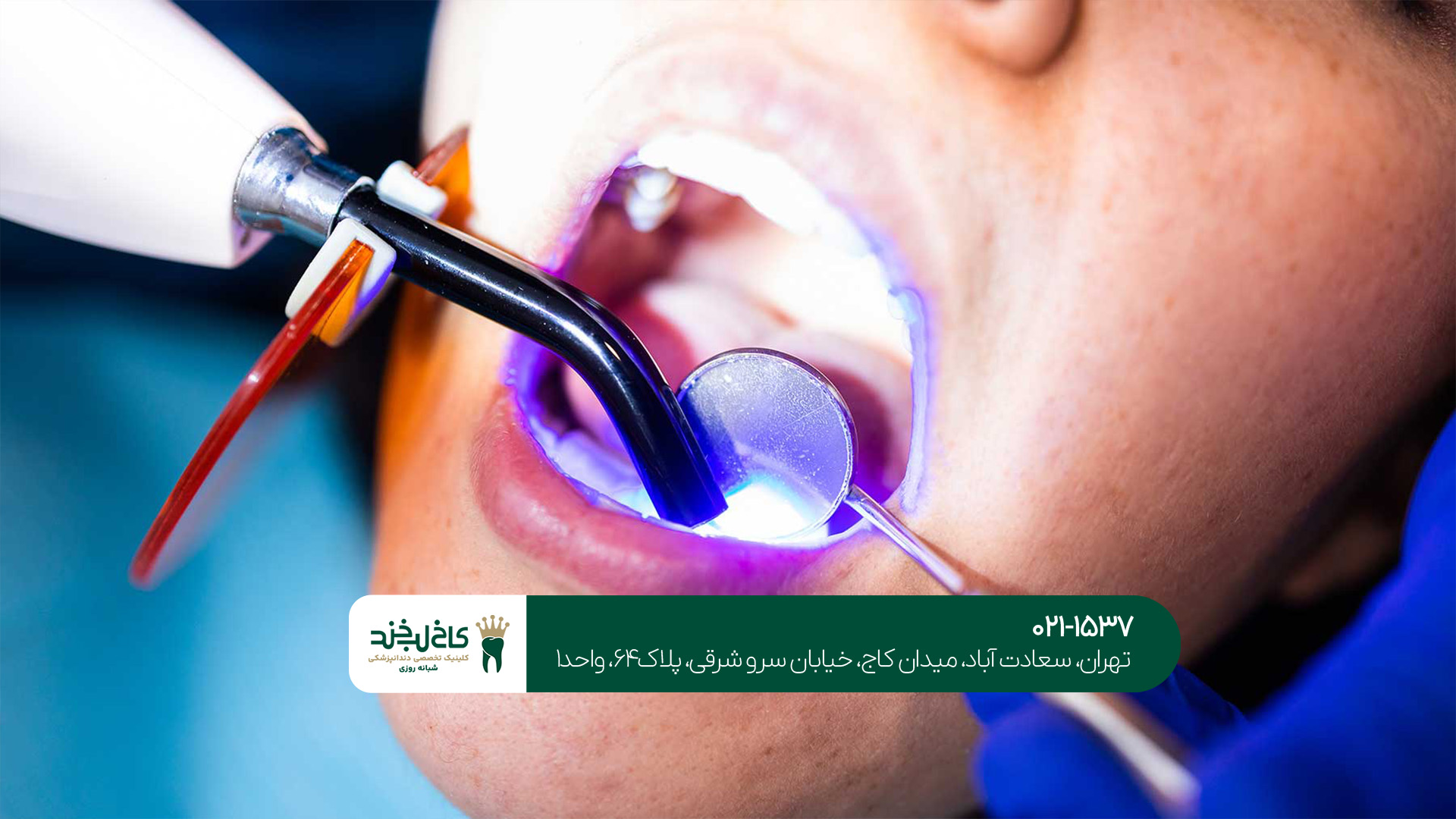 بهترین دکتر کامپوزیت تهران بهترین دکتر کامپوزیت تهران