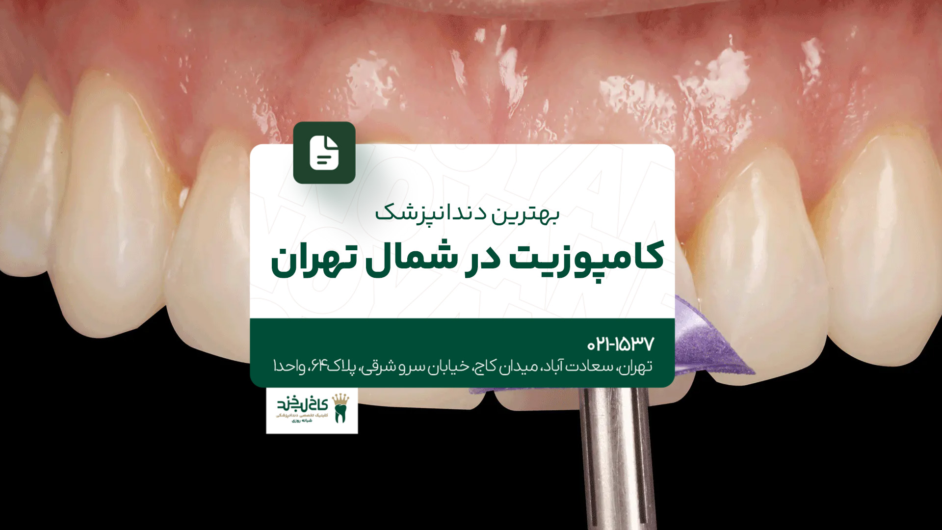 بهترین دندانپزشک کامپوزیت در شمال تهران بهترین دندانپزشک کامپوزیت در شمال تهران
