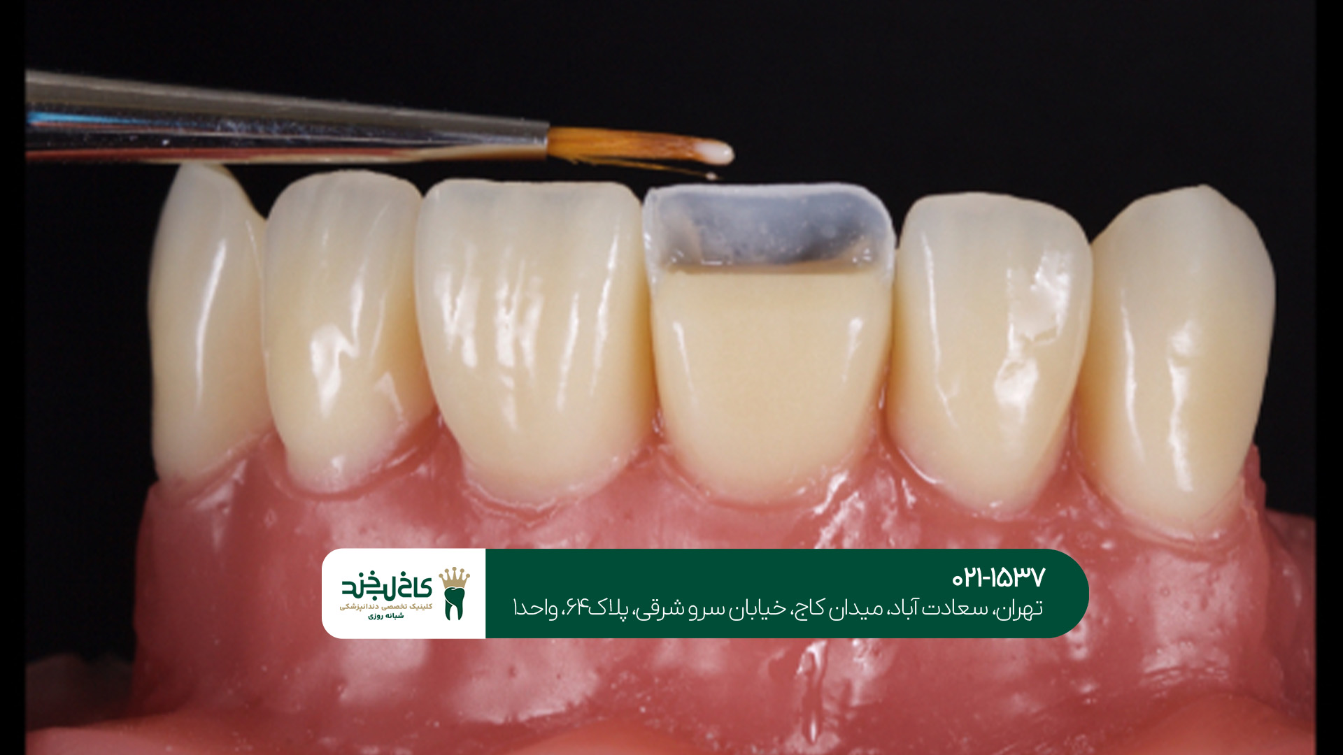 بهترین دندانپزشک کامپوزیت در شمال تهران بهترین دندانپزشک کامپوزیت در شمال تهران