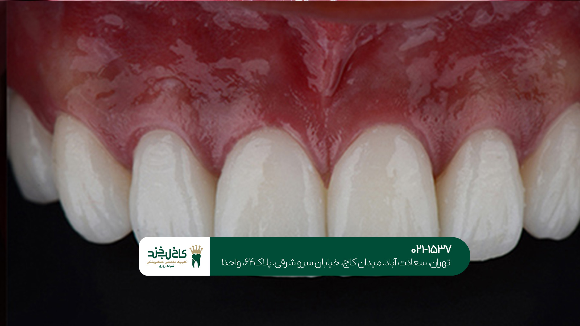 بهترین دندانپزشک کامپوزیت در شمال تهران بهترین دندانپزشک کامپوزیت در شمال تهران