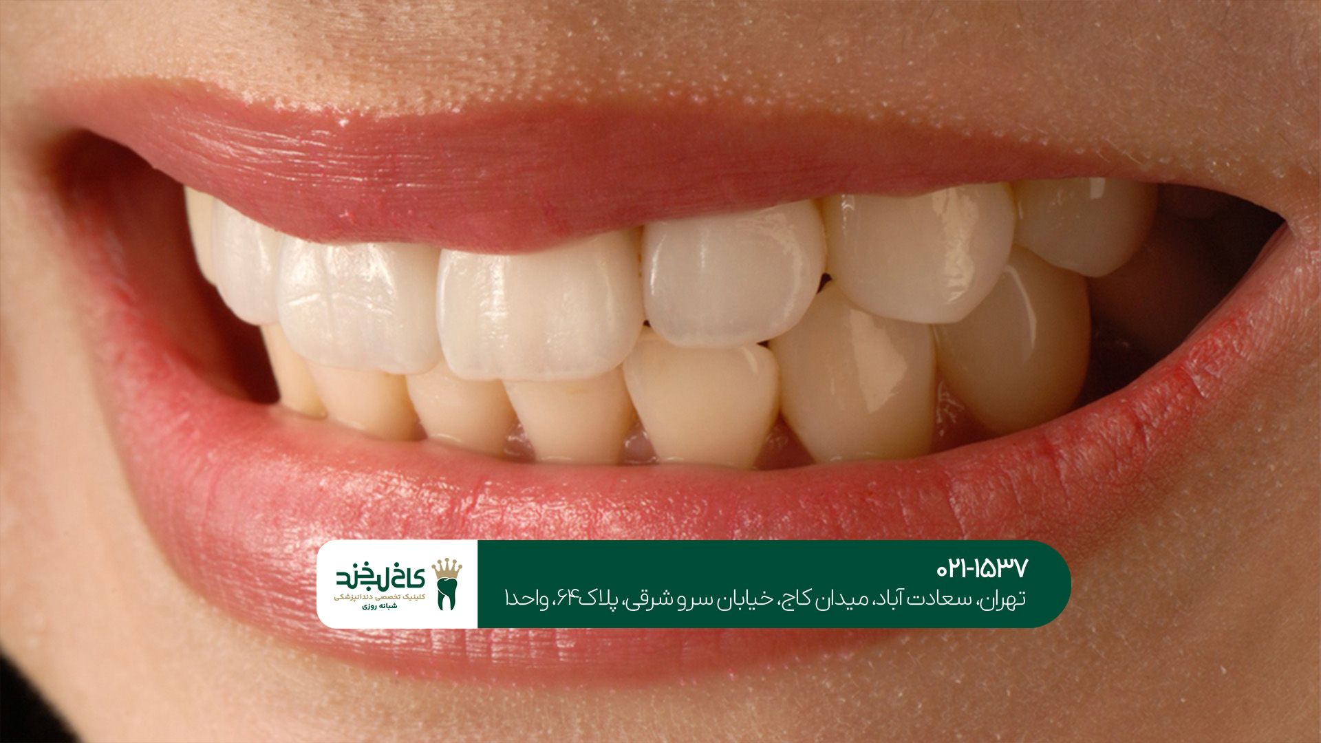 بهترین دندانپزشک کامپوزیت در شمال تهران بهترین دندانپزشک کامپوزیت در شمال تهران