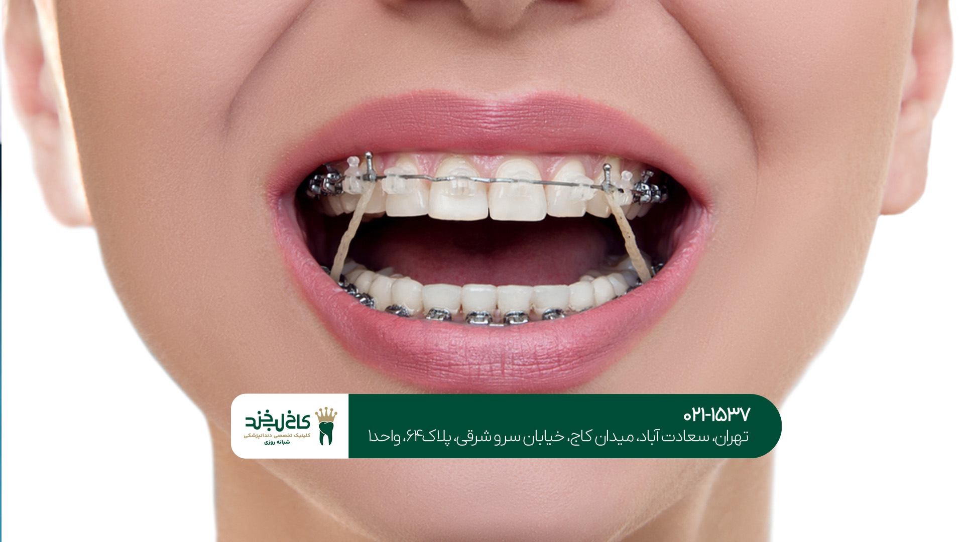 بهترین متخصص ارتودنسی شمال تهران بهترین متخصص ارتودنسی شمال تهران