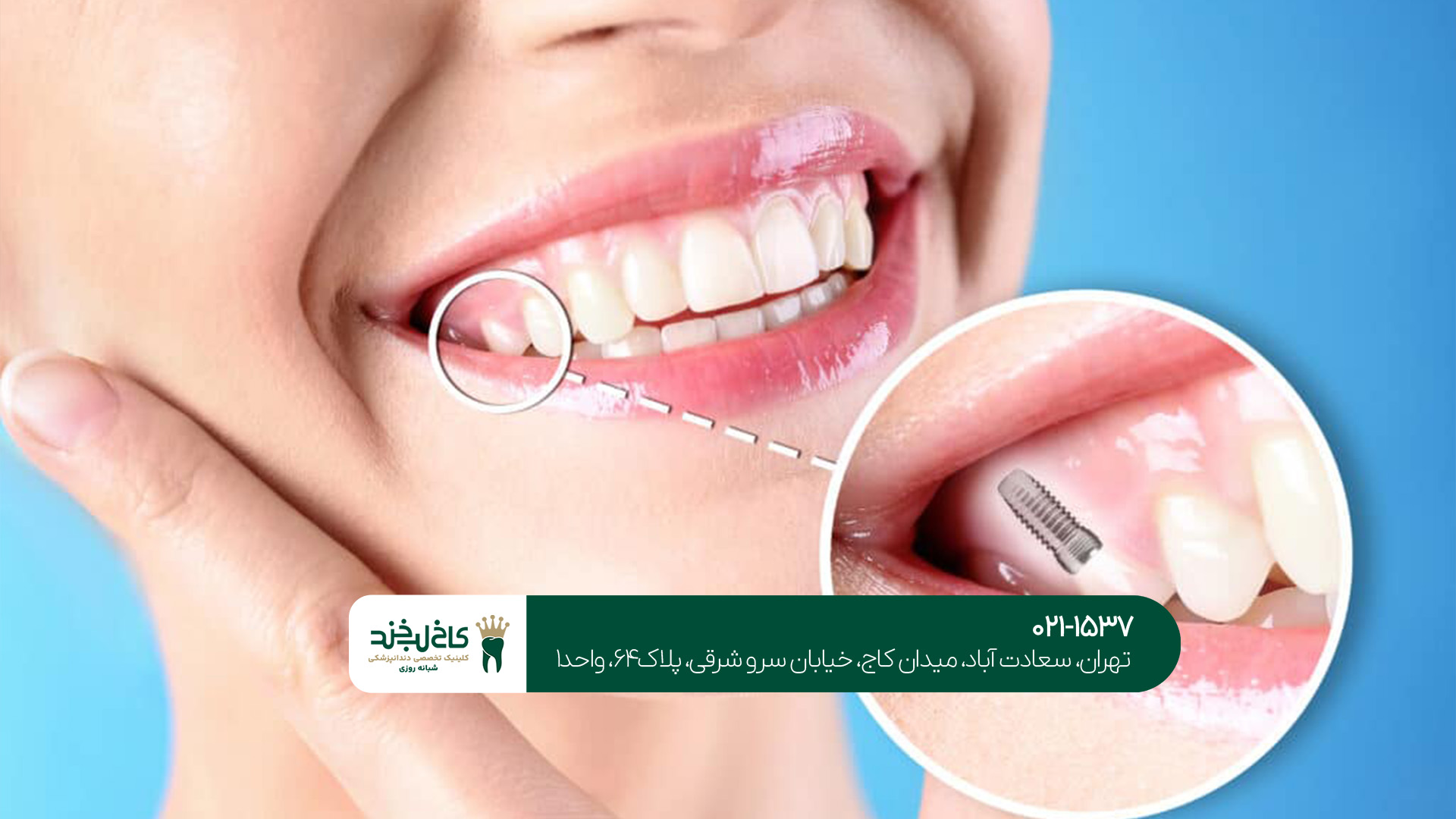 تفاوت کامپوزیت و لمینت دندان تفاوت کامپوزیت و لمینت دندان