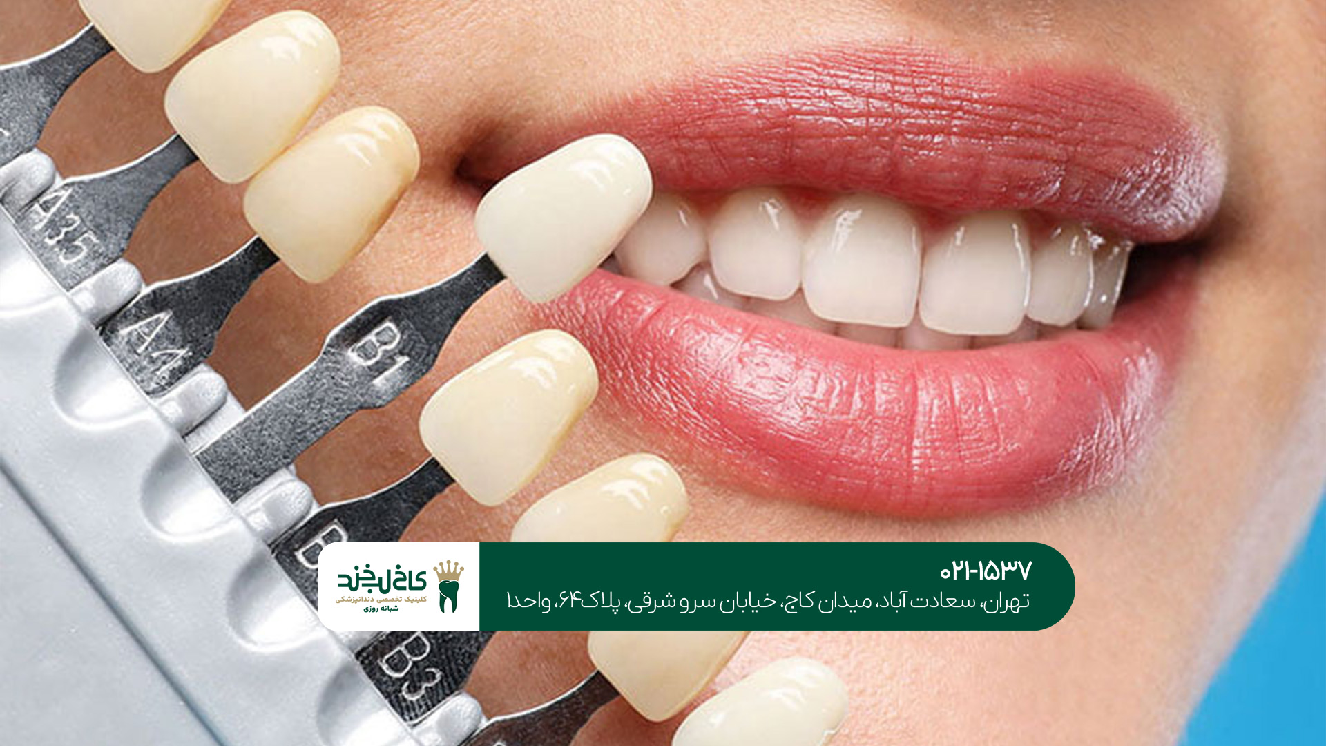 تفاوت کامپوزیت و لمینت دندان تفاوت کامپوزیت و لمینت دندان