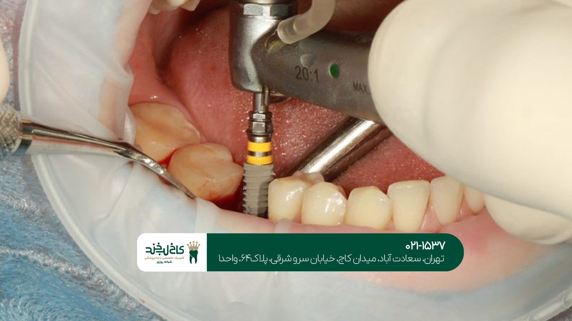 کلینیک دندانپزشکی تخصصی ایمپلنت کلینیک دندانپزشکی تخصصی ایمپلنت