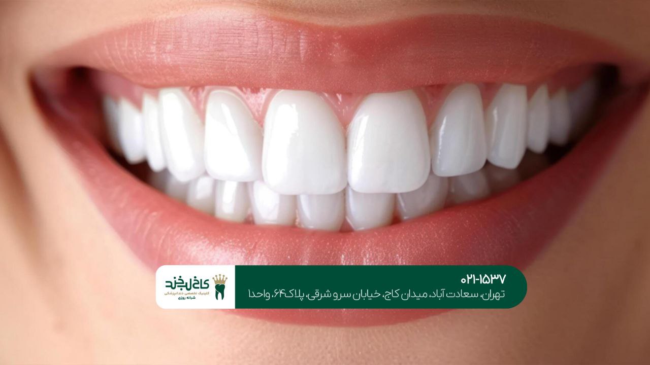 لمینت قسطی دندان