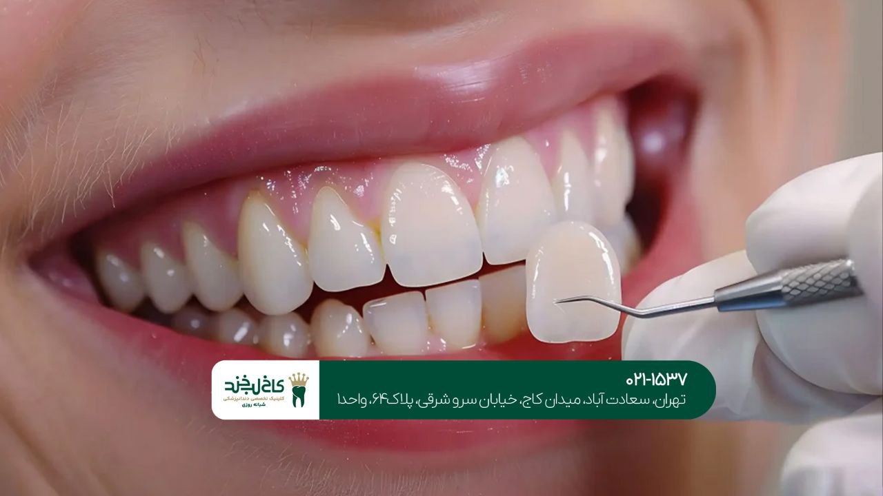 لمینت قسطی دندان