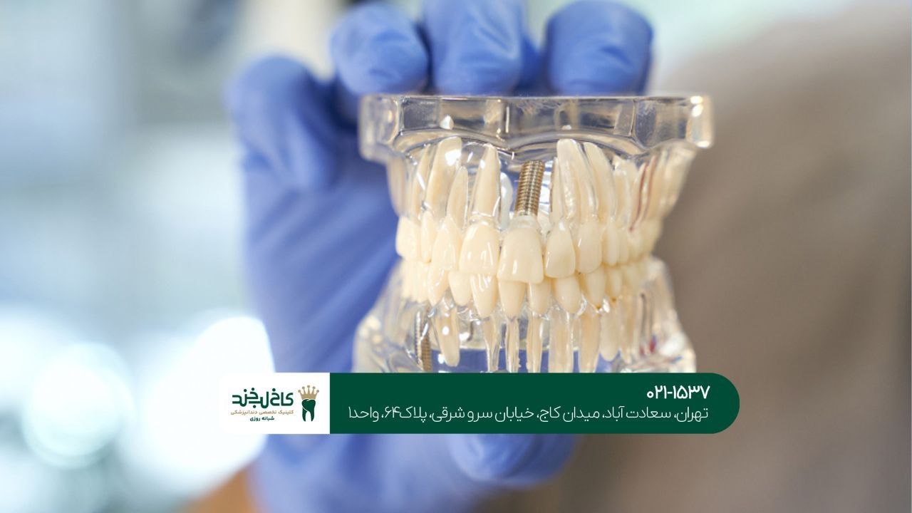 ایمپلنت دیجیتال دندان