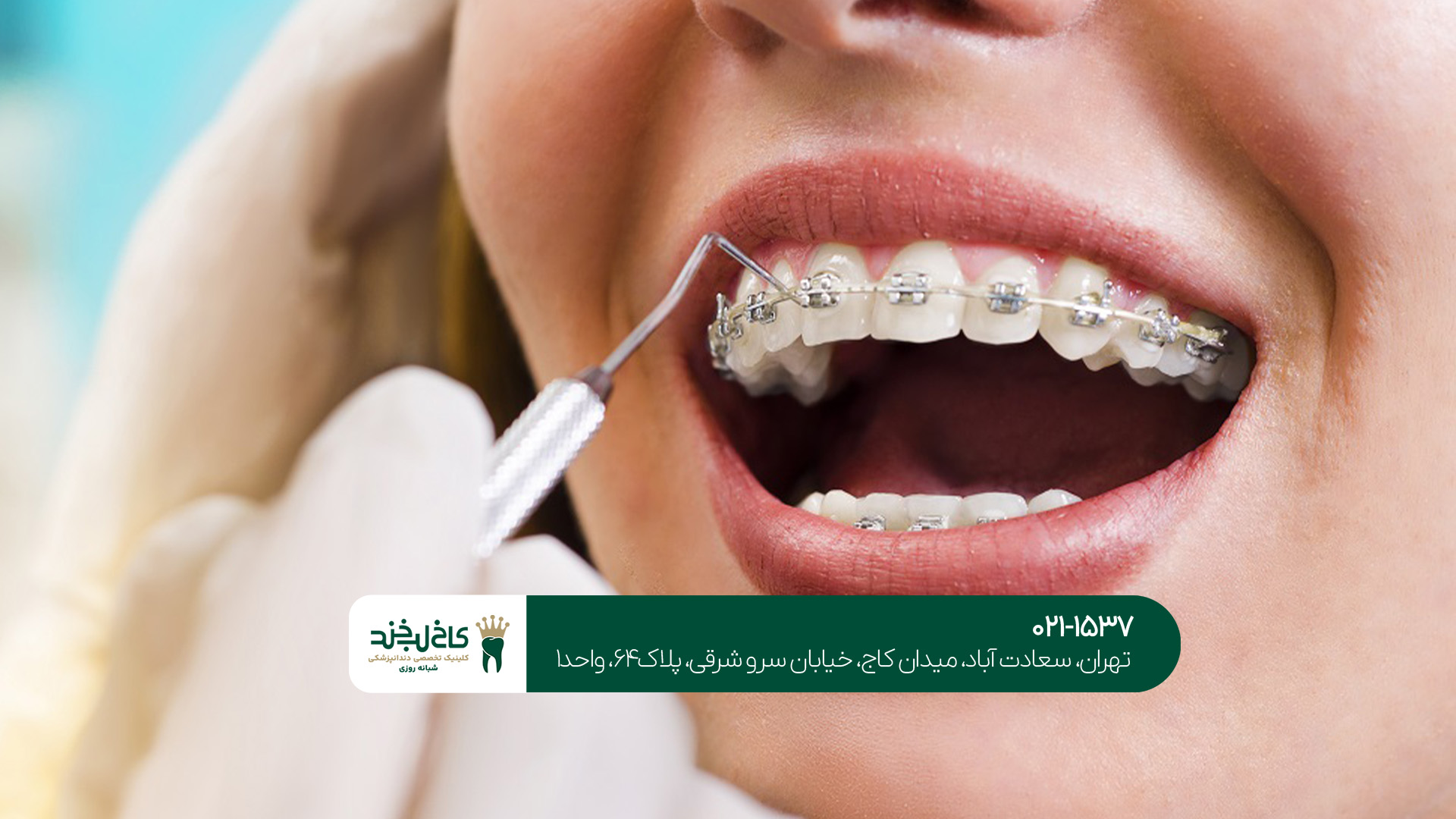 مراحل انجام ارتودنسی مراحل انجام ارتودنسی