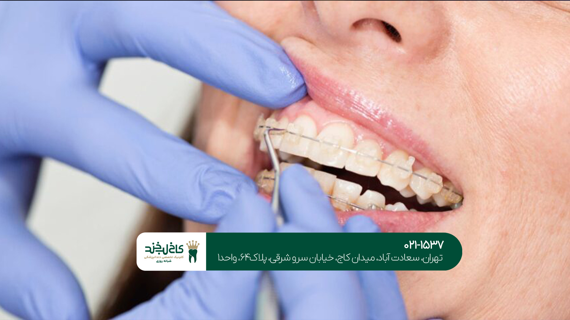 تفاوت ارتودنسی ثابت و متحرک تفاوت ارتودنسی ثابت و متحرک