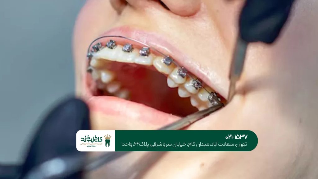 ارتودنسی بزرگسال