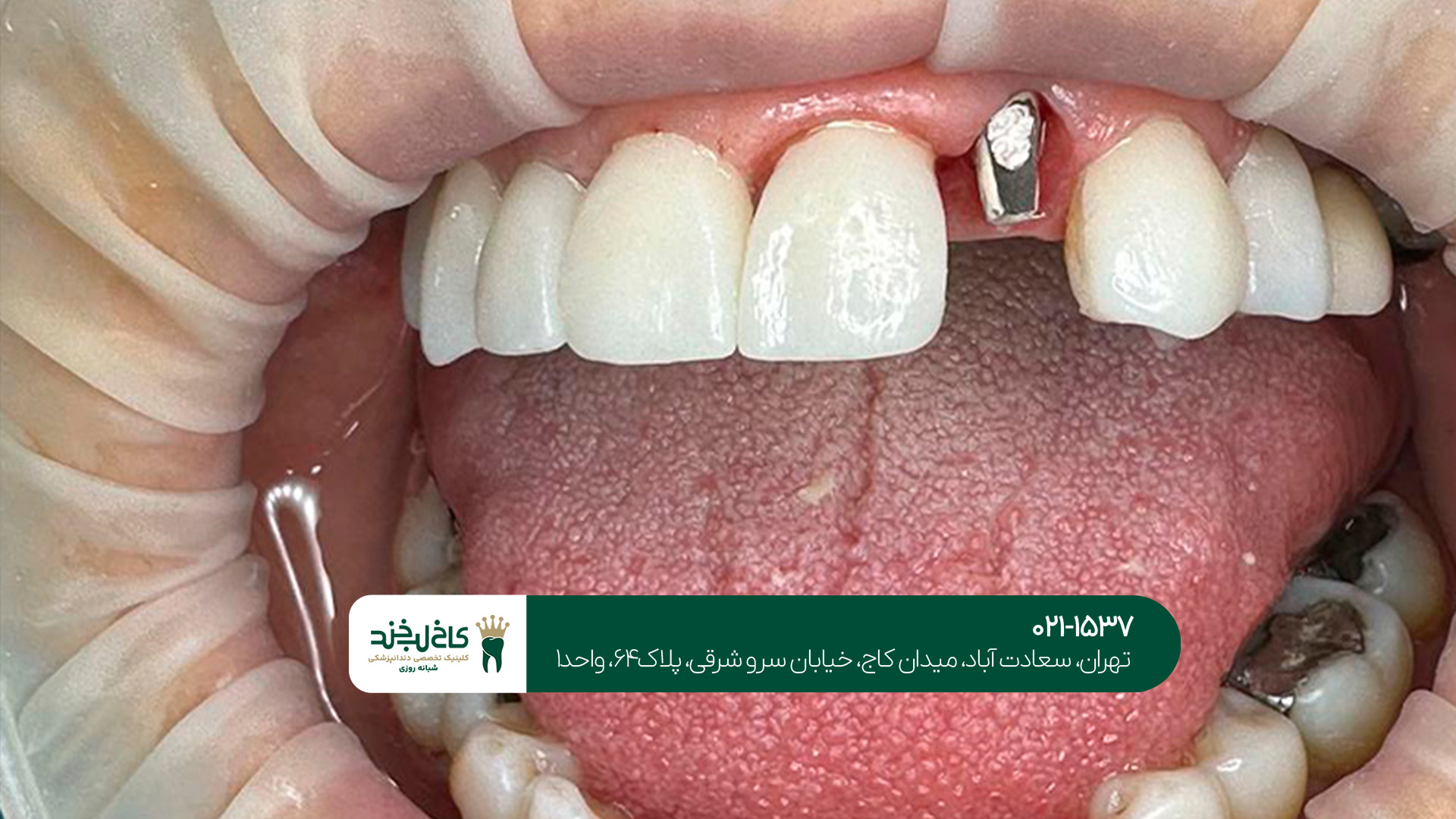 ایمپلنت بدون درد و سریع ایمپلنت بدون درد و سریع