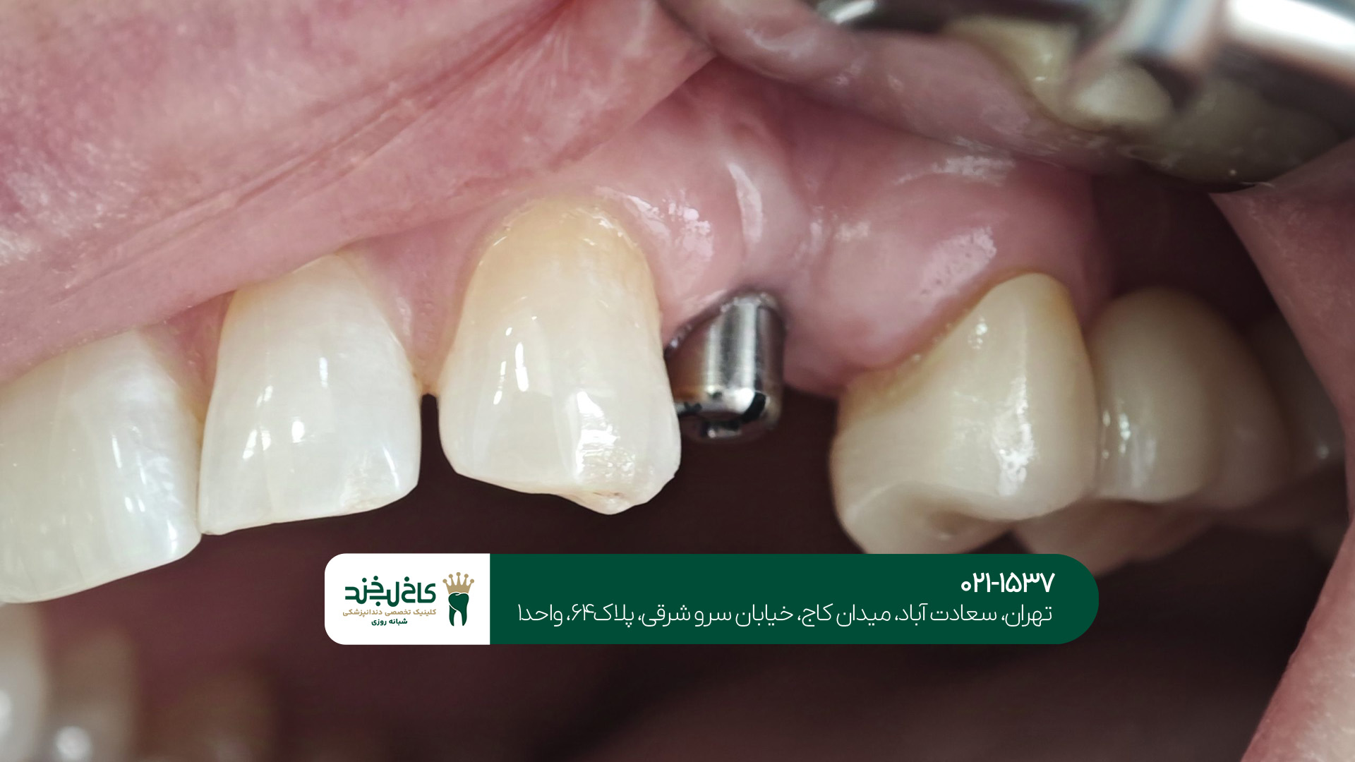 ایمپلنت بدون درد و سریع ایمپلنت بدون درد و سریع