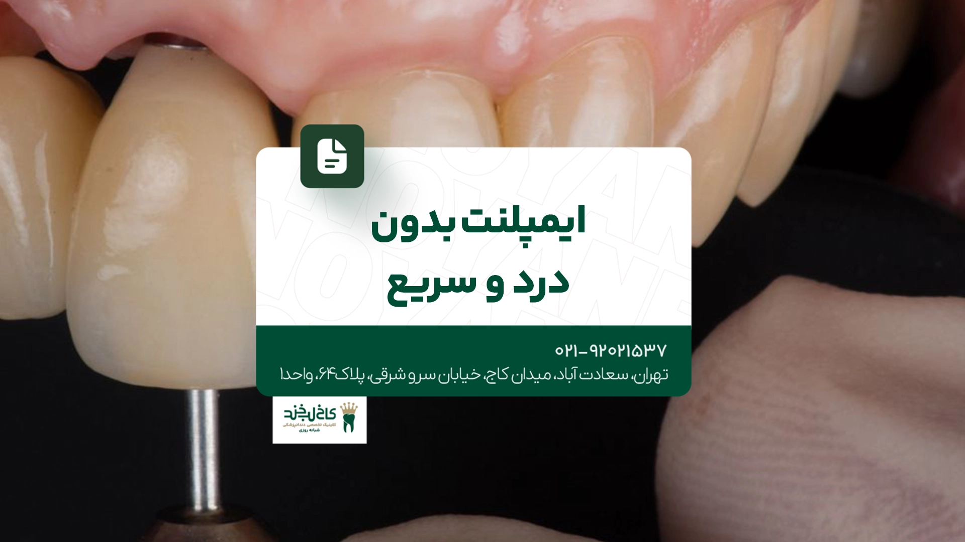 ایمپلنت بدون درد و سریع ایمپلنت بدون درد و سریع