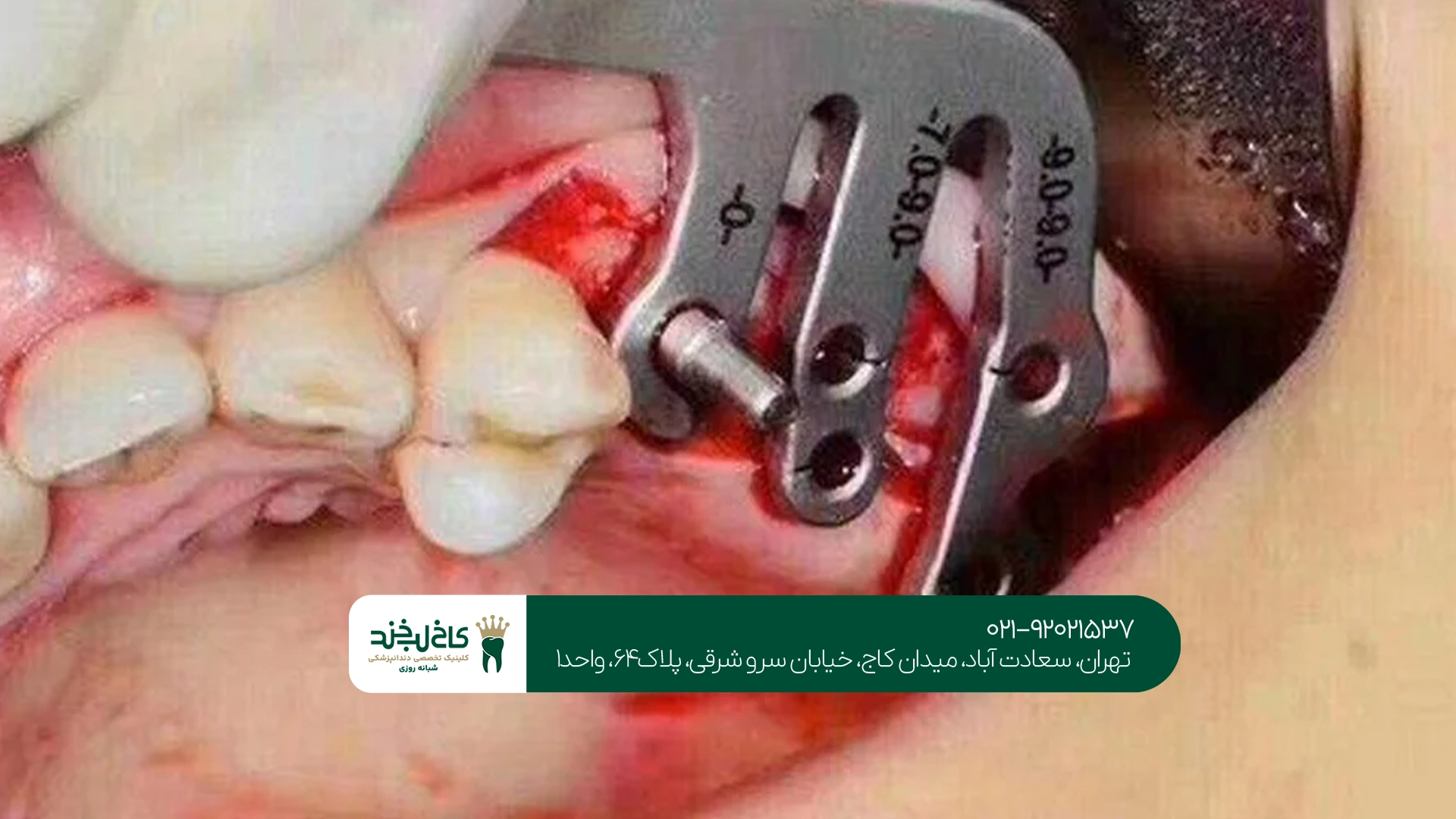 ایمپلنت بدون درد دندان ایمپلنت بدون درد دندان