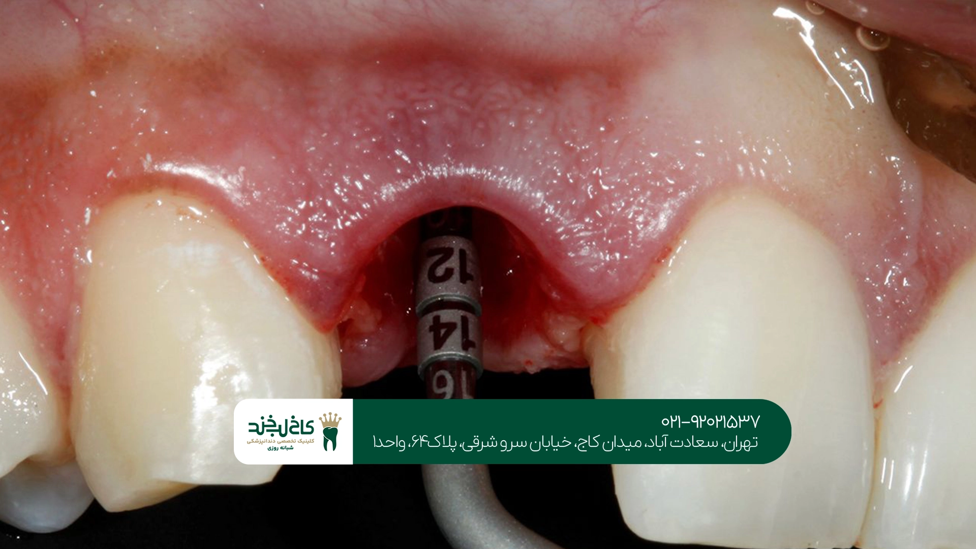 ایمپلنت دندان در تهران ایمپلنت دندان در تهران