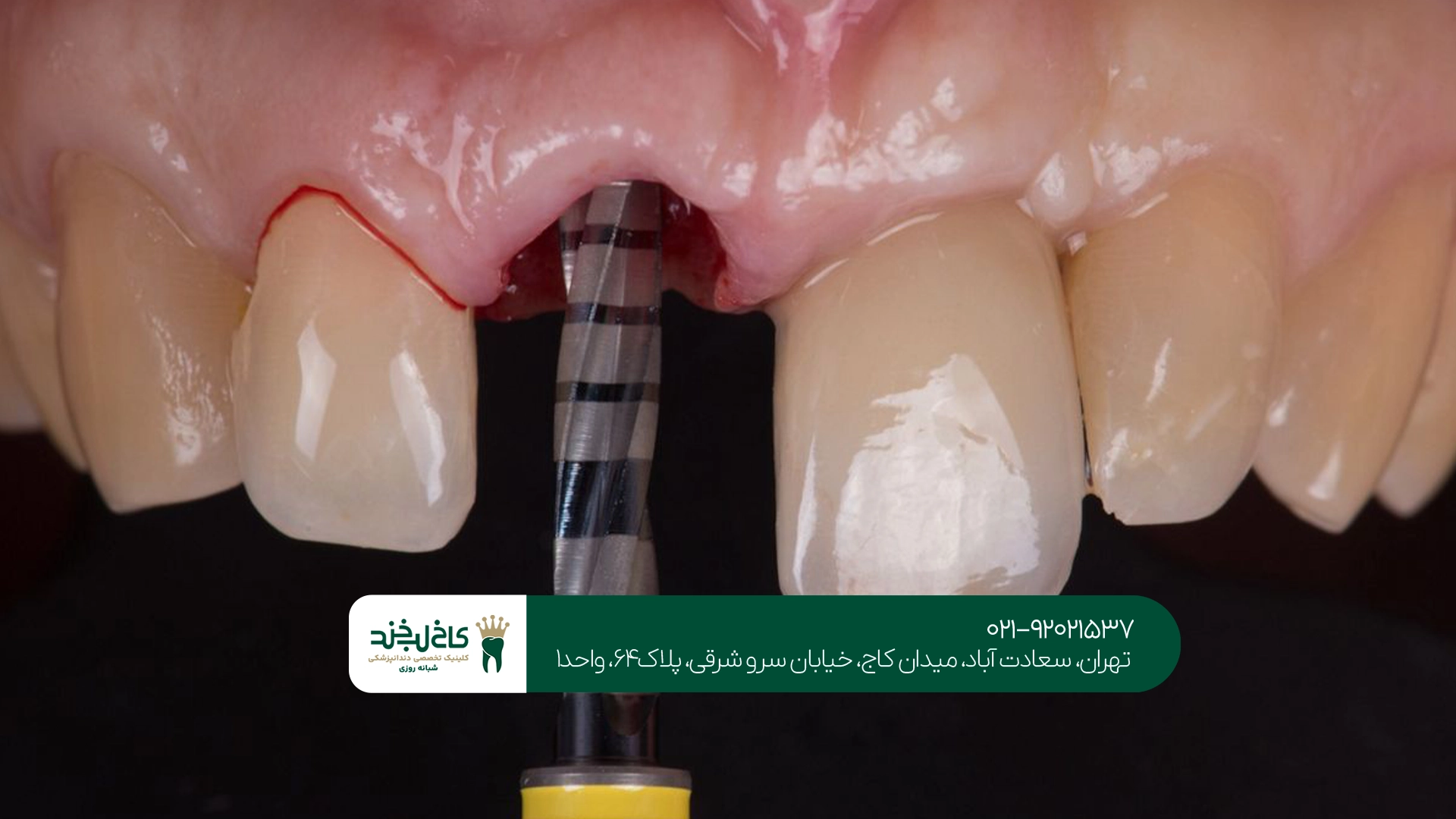 ایمپلنت بدون درد در تهران ایمپلنت بدون درد در تهران