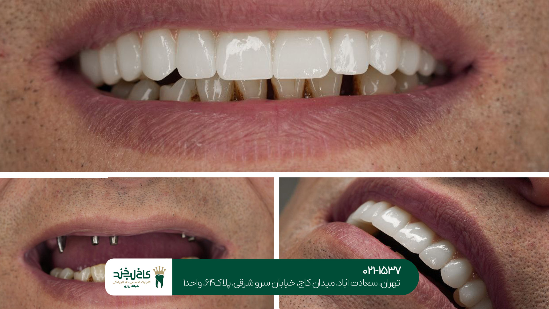 ایمپلنت دندان