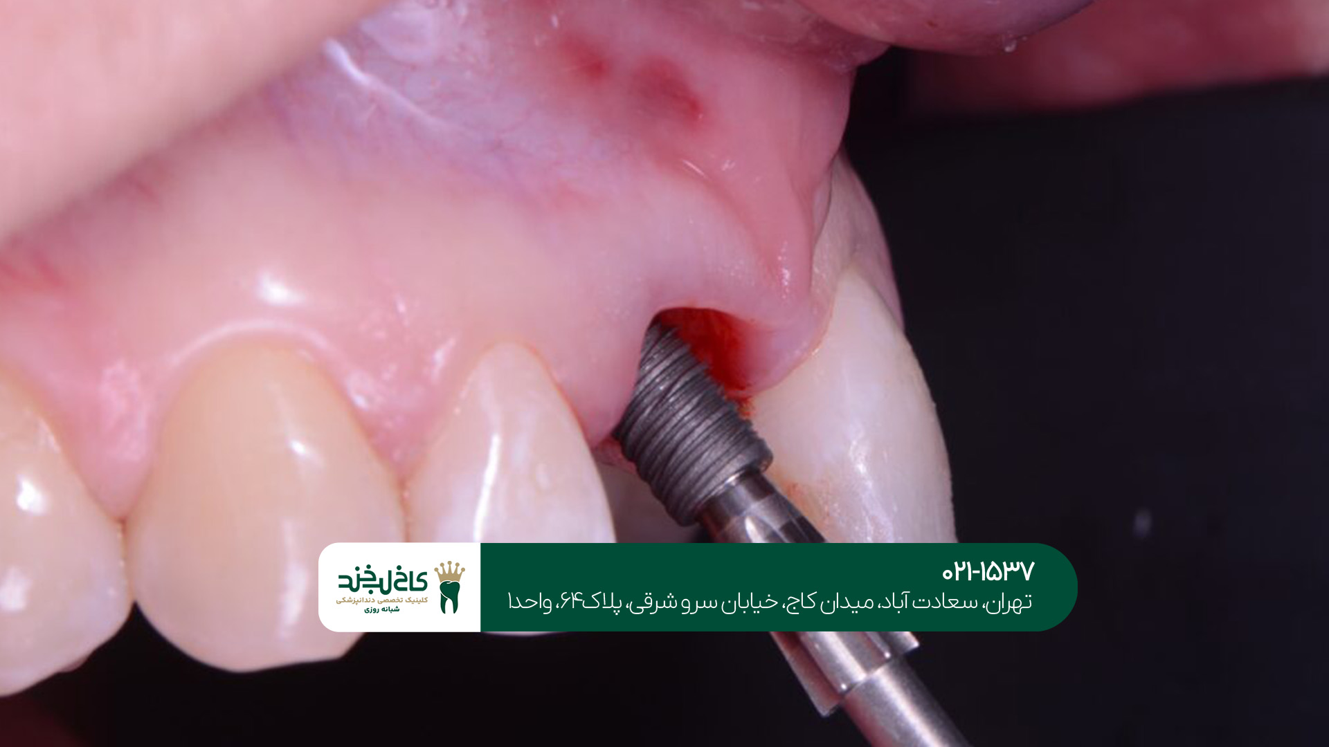 ایمپلنت دندان تهران ایمپلنت دندان تهران