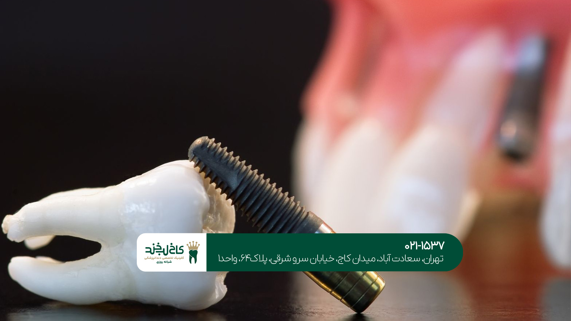 ایمپلنت دندان تهران ایمپلنت دندان تهران