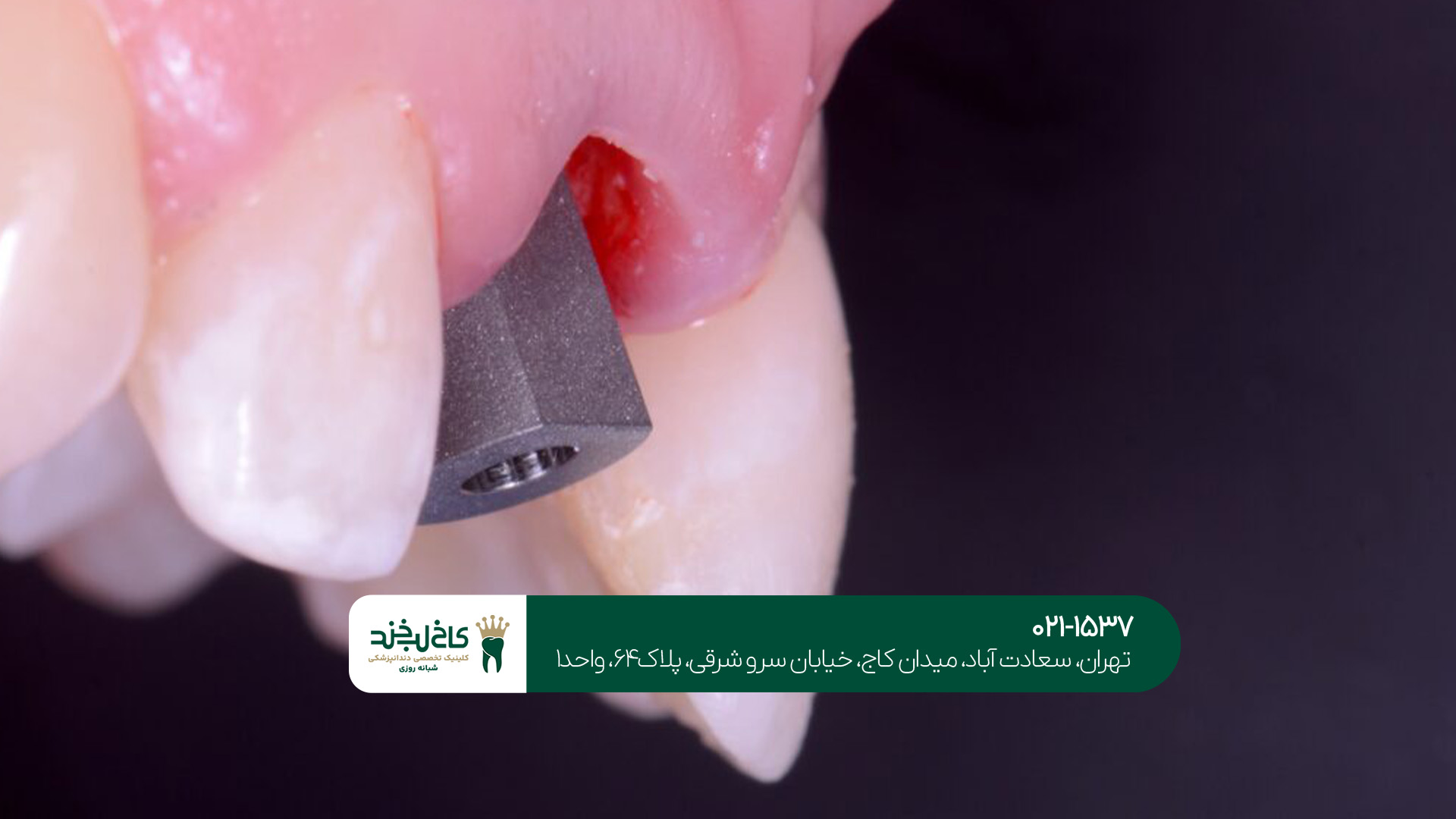 ایمپلنت دندان تهران ایمپلنت دندان تهران