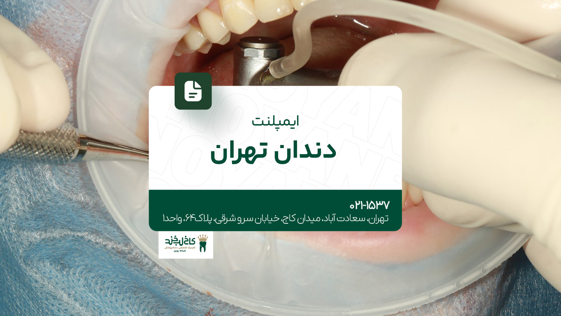 ایمپلنت دندان تهران ایمپلنت دندان تهران
