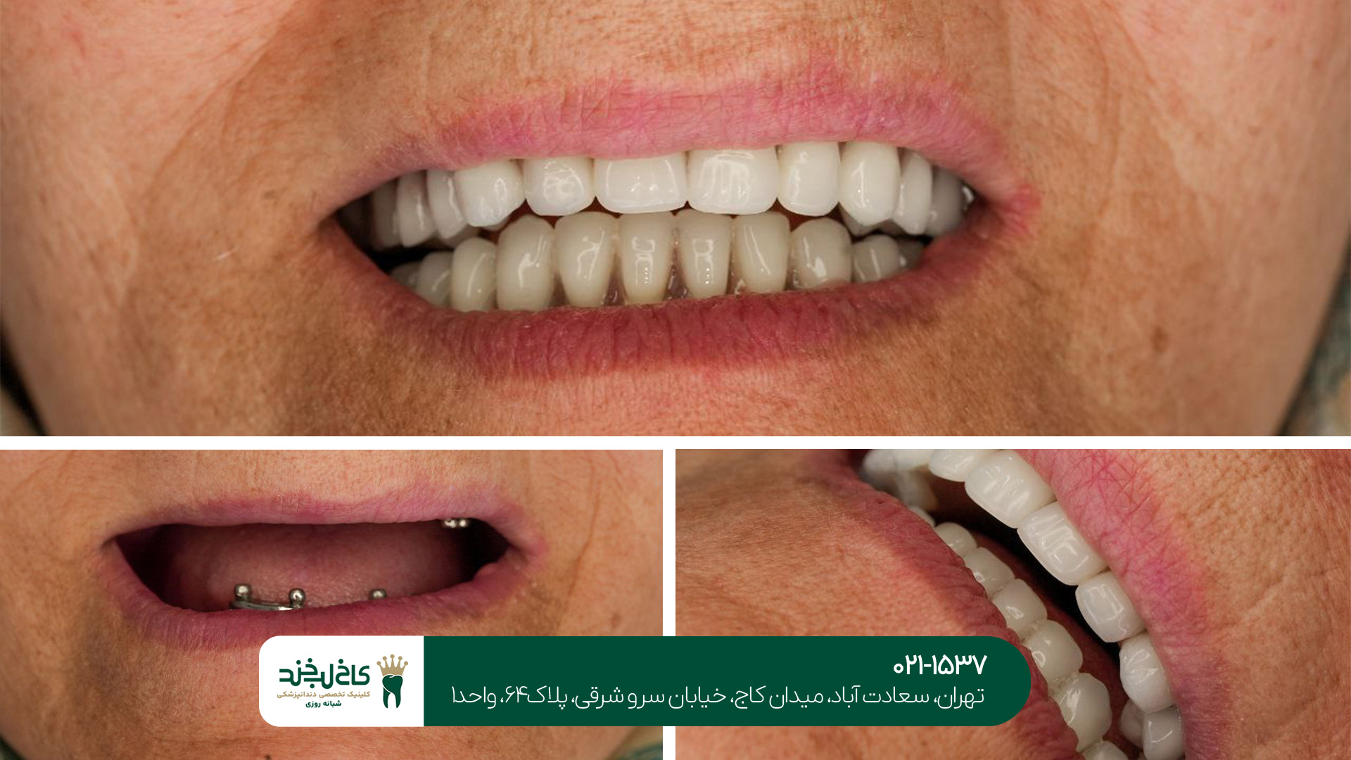 ایمپلنت دندان