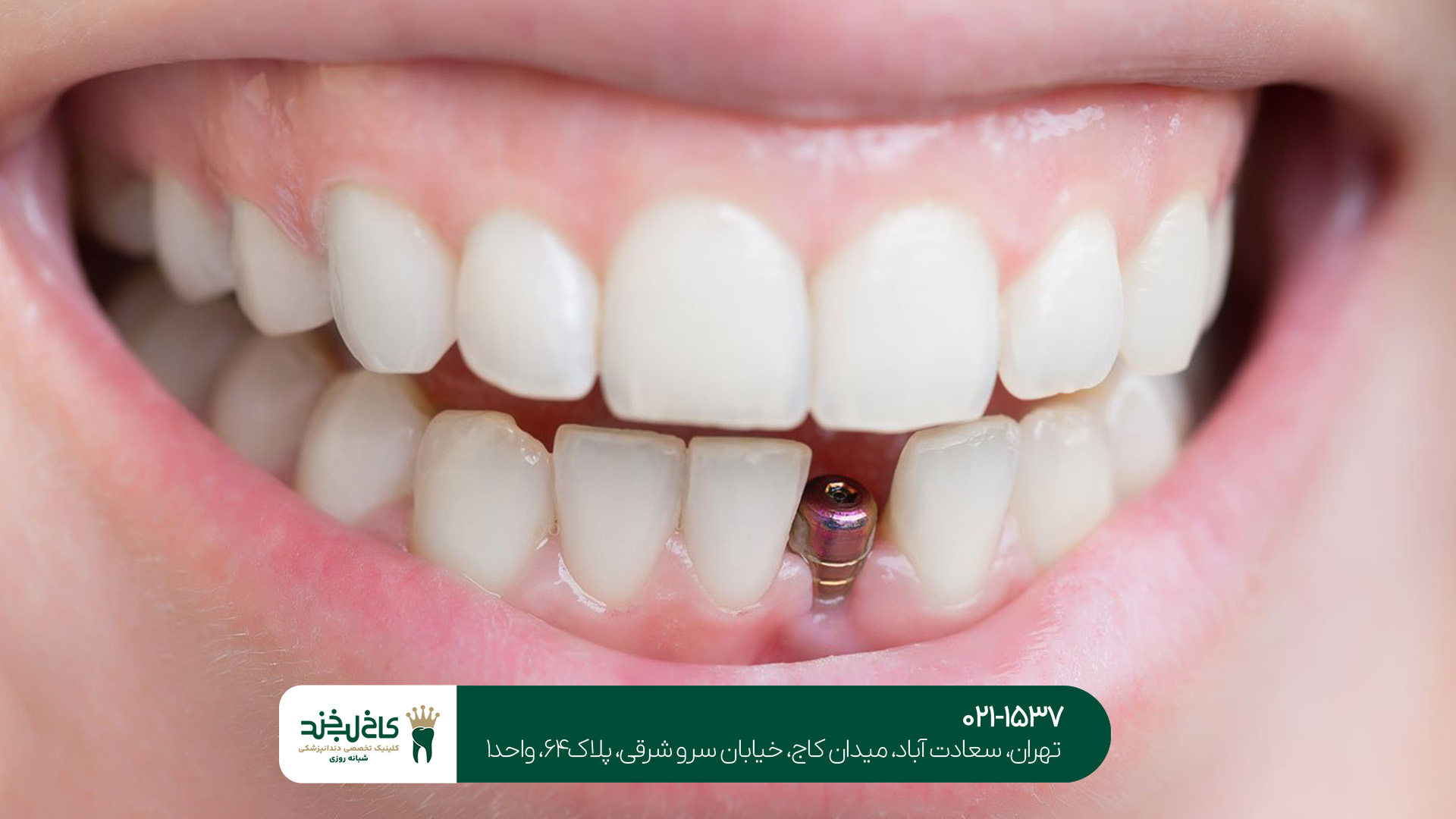 دندانپزشکی ایمپلنت