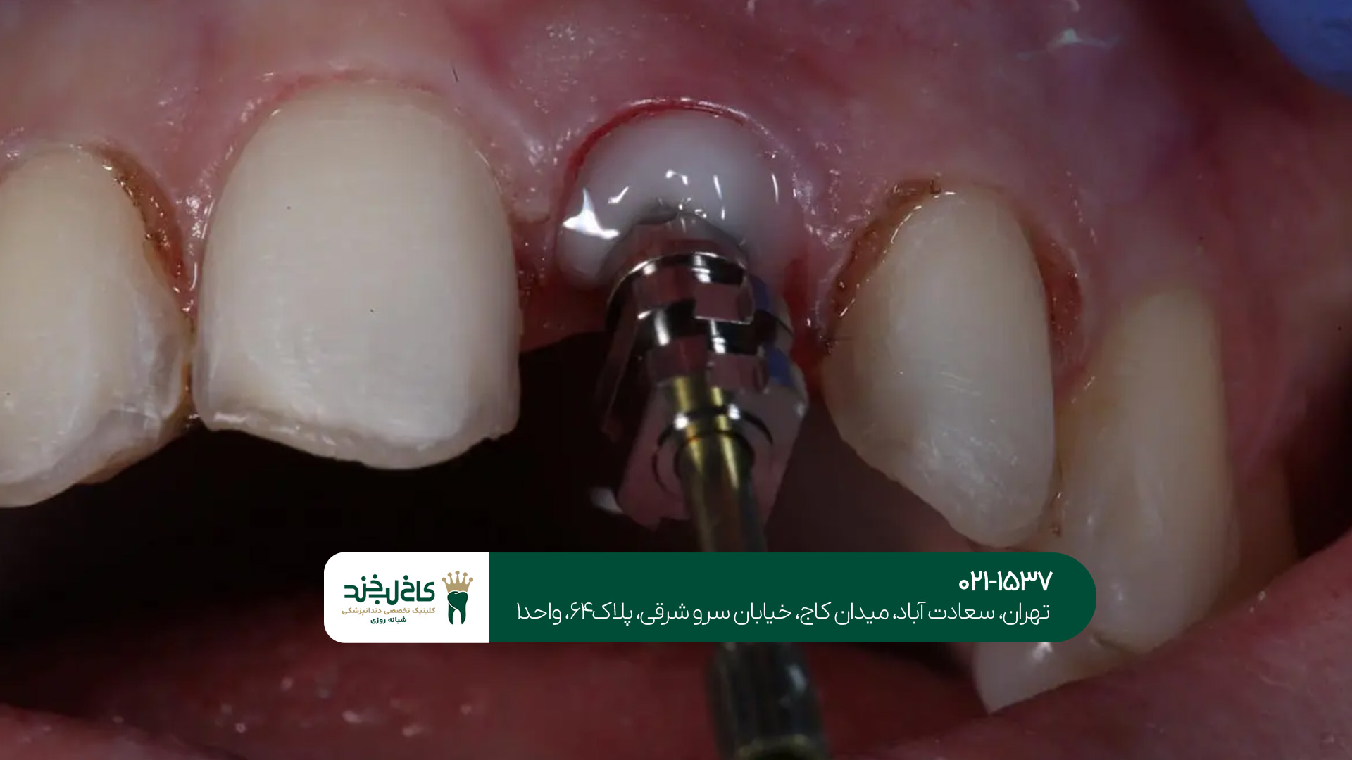 ایمپلنت یکروزه تهران ایمپلنت یکروزه تهران