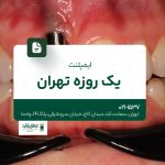 ایمپلنت یک‌روزه تهران