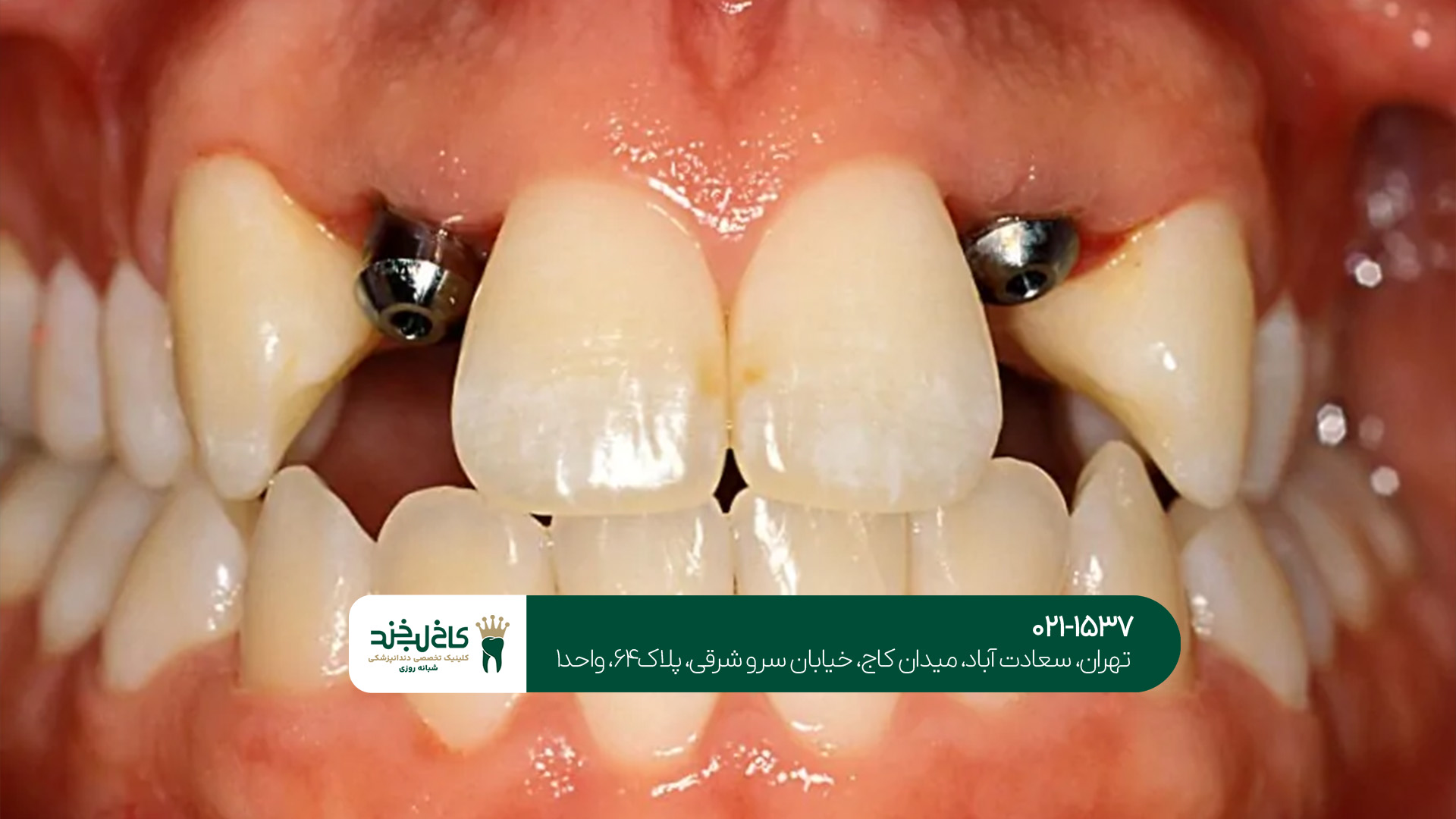 ایمپلنت یکروزه تهران ایمپلنت یکروزه تهران