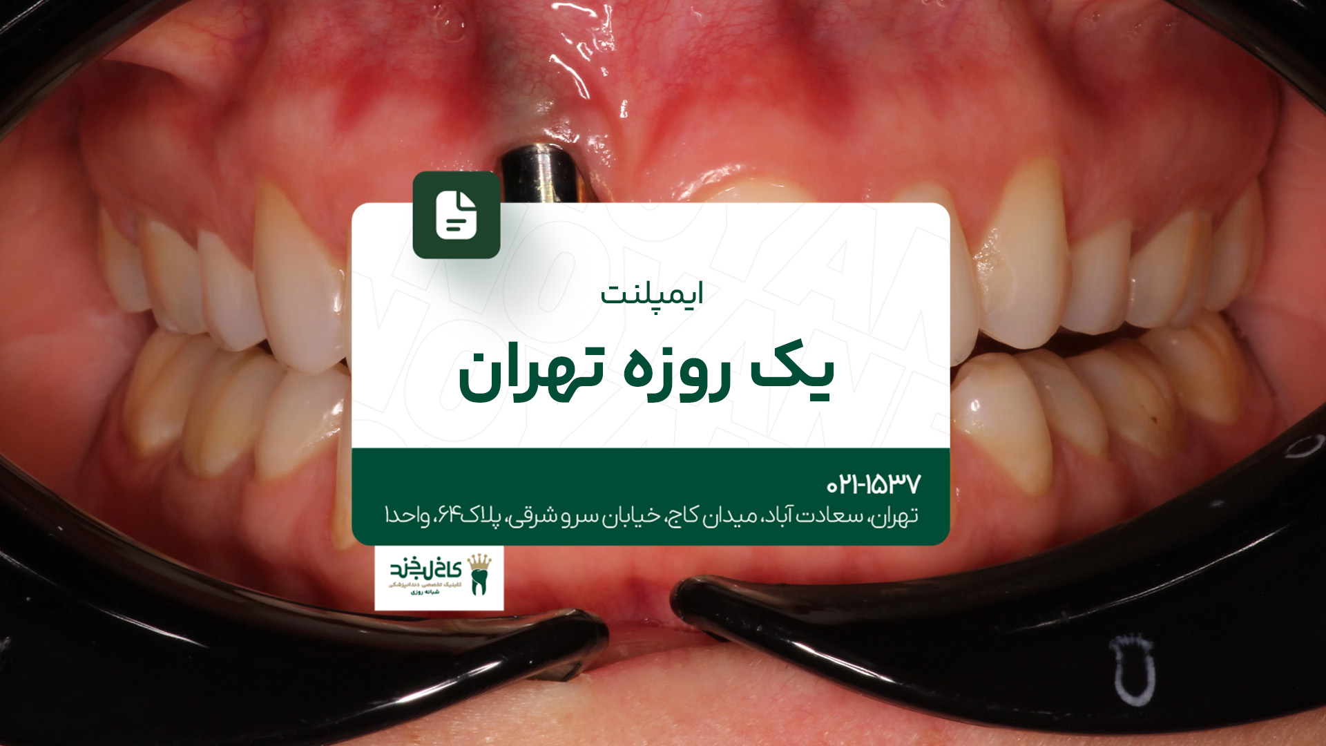 ایمپلنت یکروزه تهران ایمپلنت یکروزه تهران