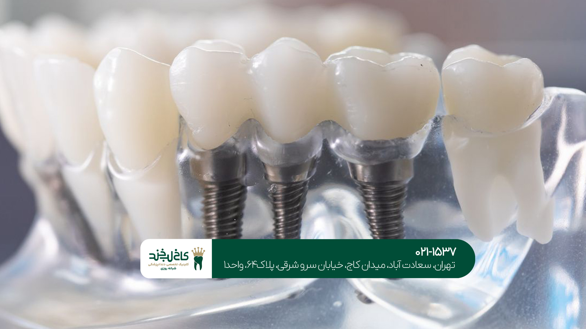 بهترین کلینیک ایمپلنت دیجیتال در تهران