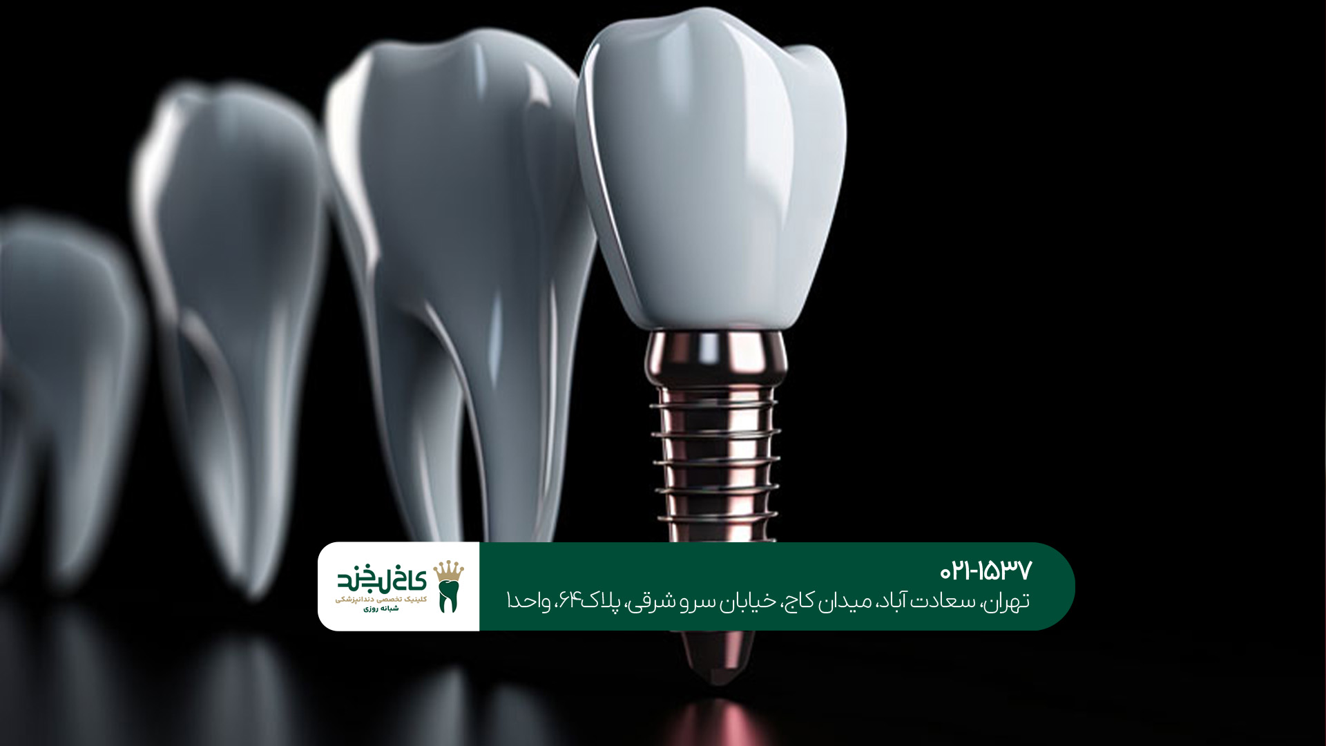 ایمپلنت دیجیتال