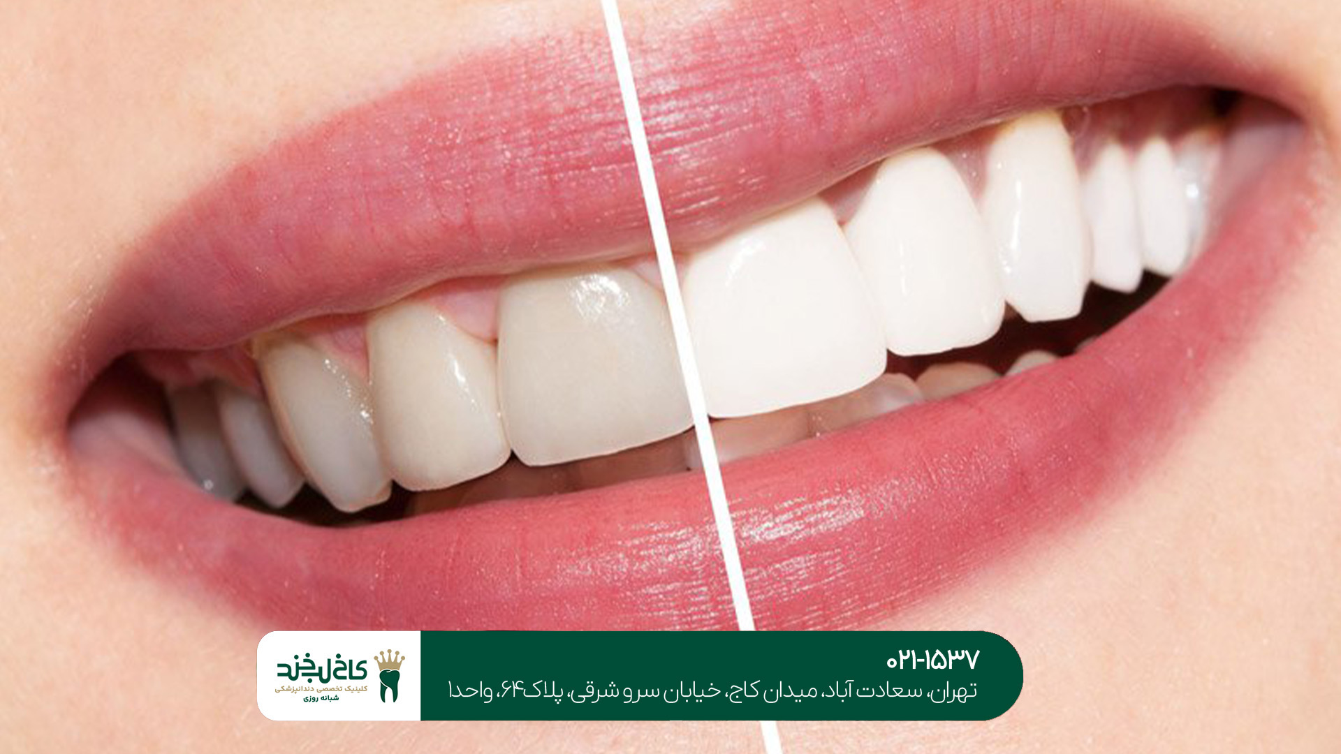 بلیچینگ دندان