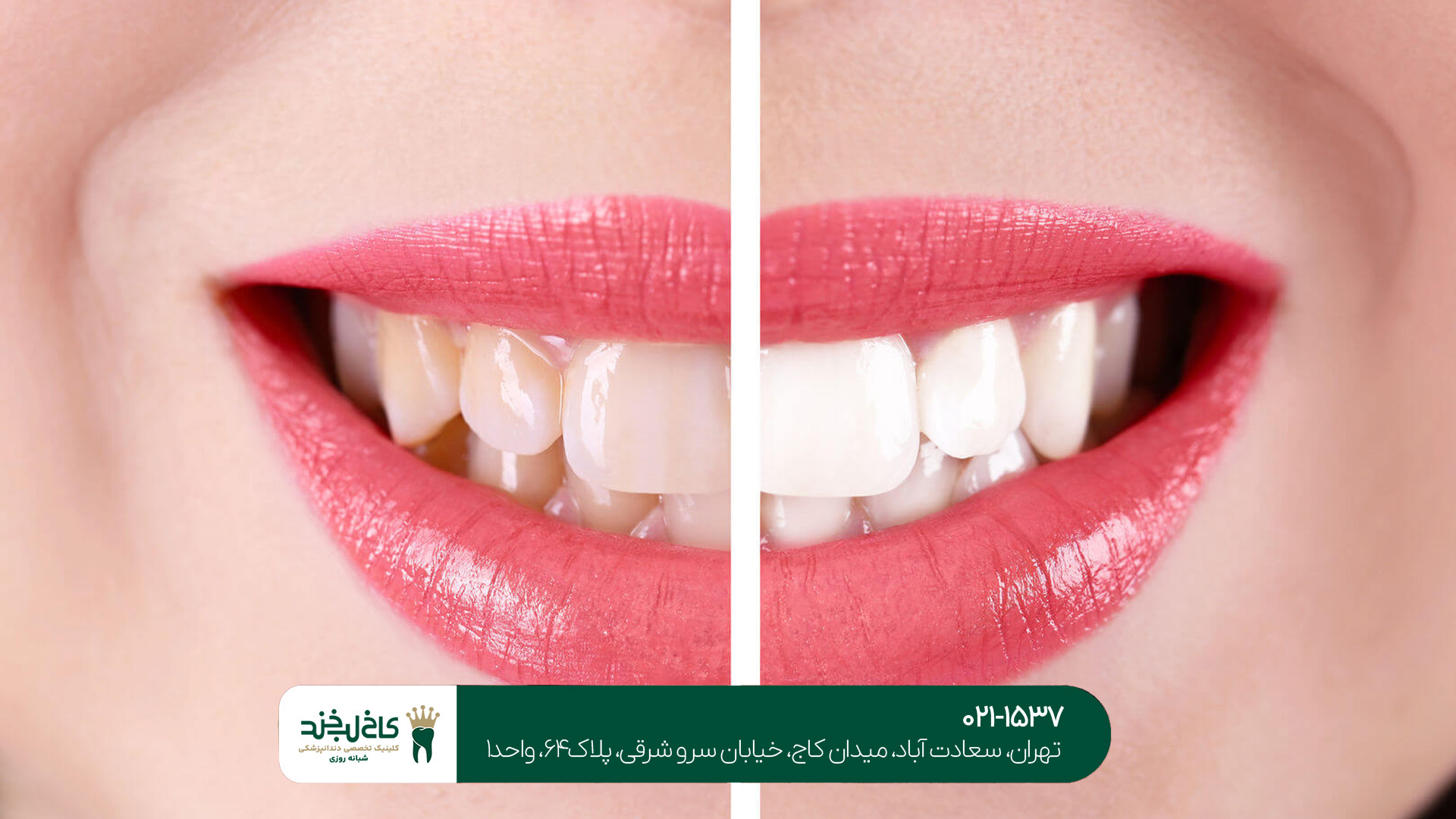 بلیچینگ دندان در تهران