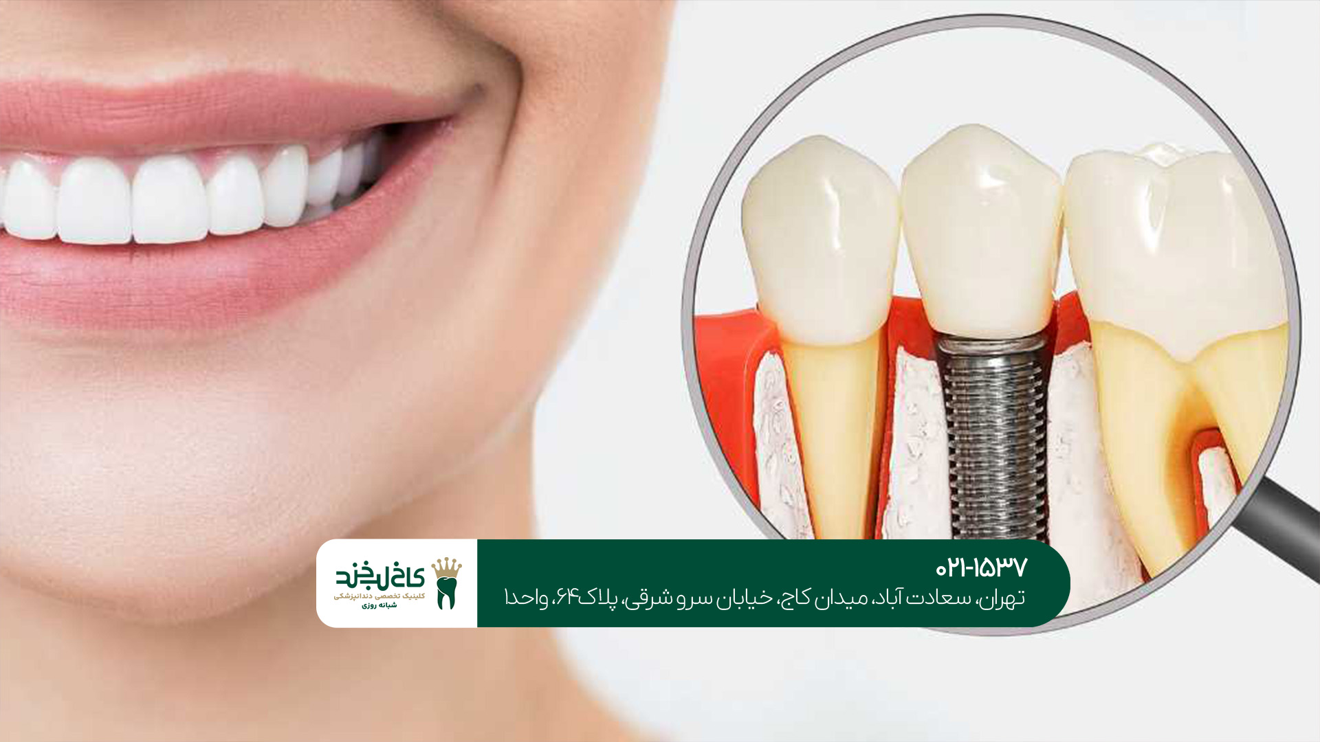 بهترین برندهای ایمپلنت دندان