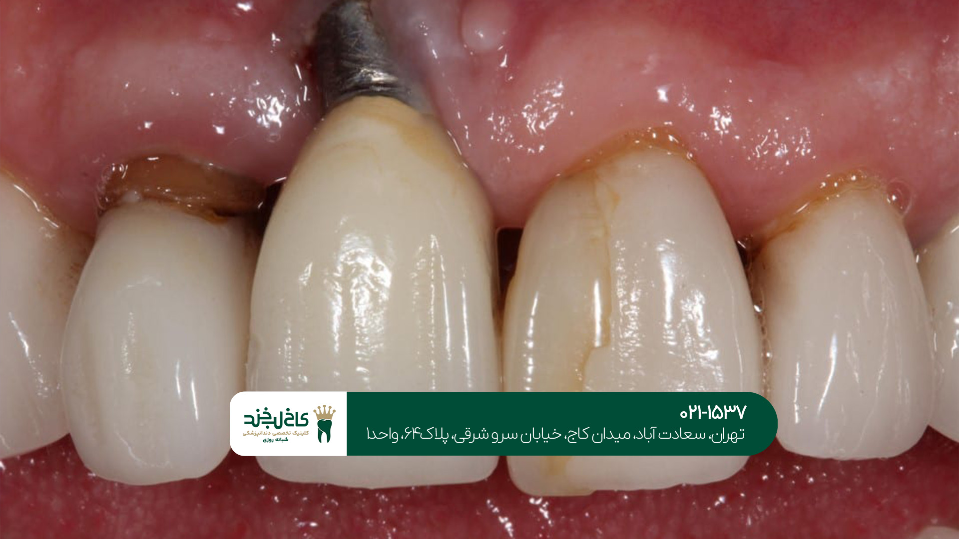 بهترین برندهای ایمپلنت دندان