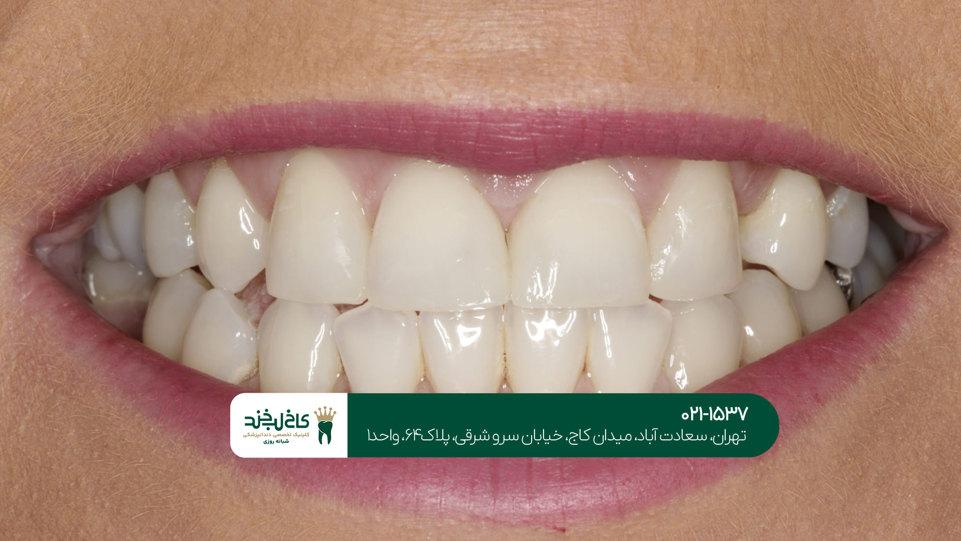 بهترین کلینیک کامپوزیت